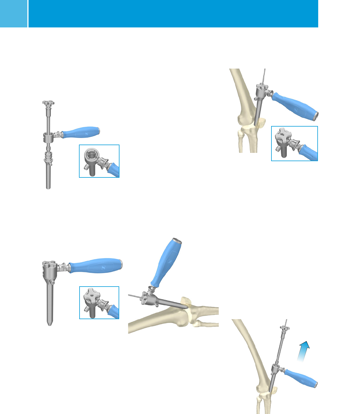 Zimmer Natural Nail System Tibia Surgical Technique