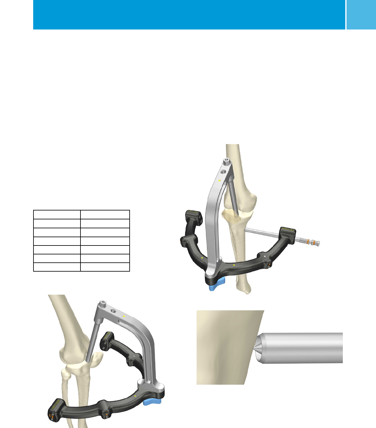 Zimmer Natural Nail System Tibia Surgical Technique