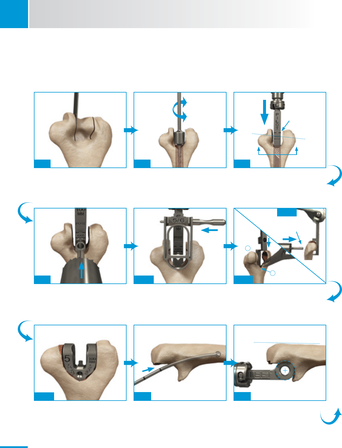 Zimmer Nexel Total Elbow Surgical Technique 97 8401 002 00
