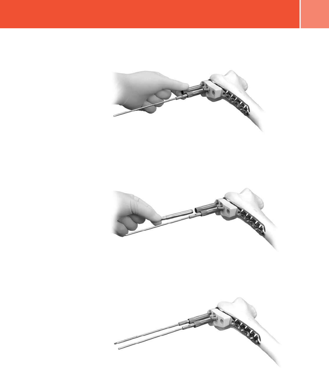 Zimmer Periarticular Distal Femoral Locking Plate Surgical Technique