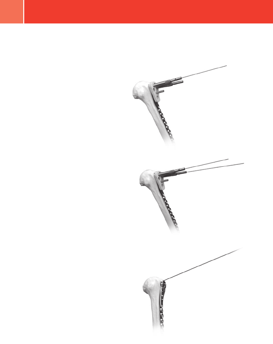 Zimmer Periarticular Proximal Humeral Locking Plate Surgical Technique