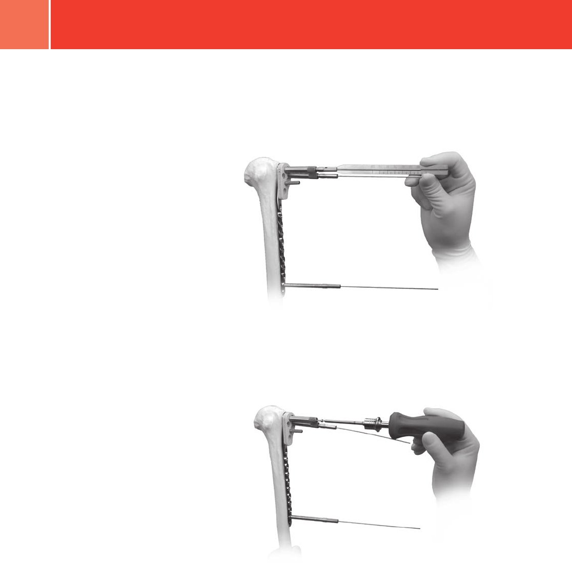 Zimmer Periarticular Proximal Humeral Locking Plate Surgical Technique