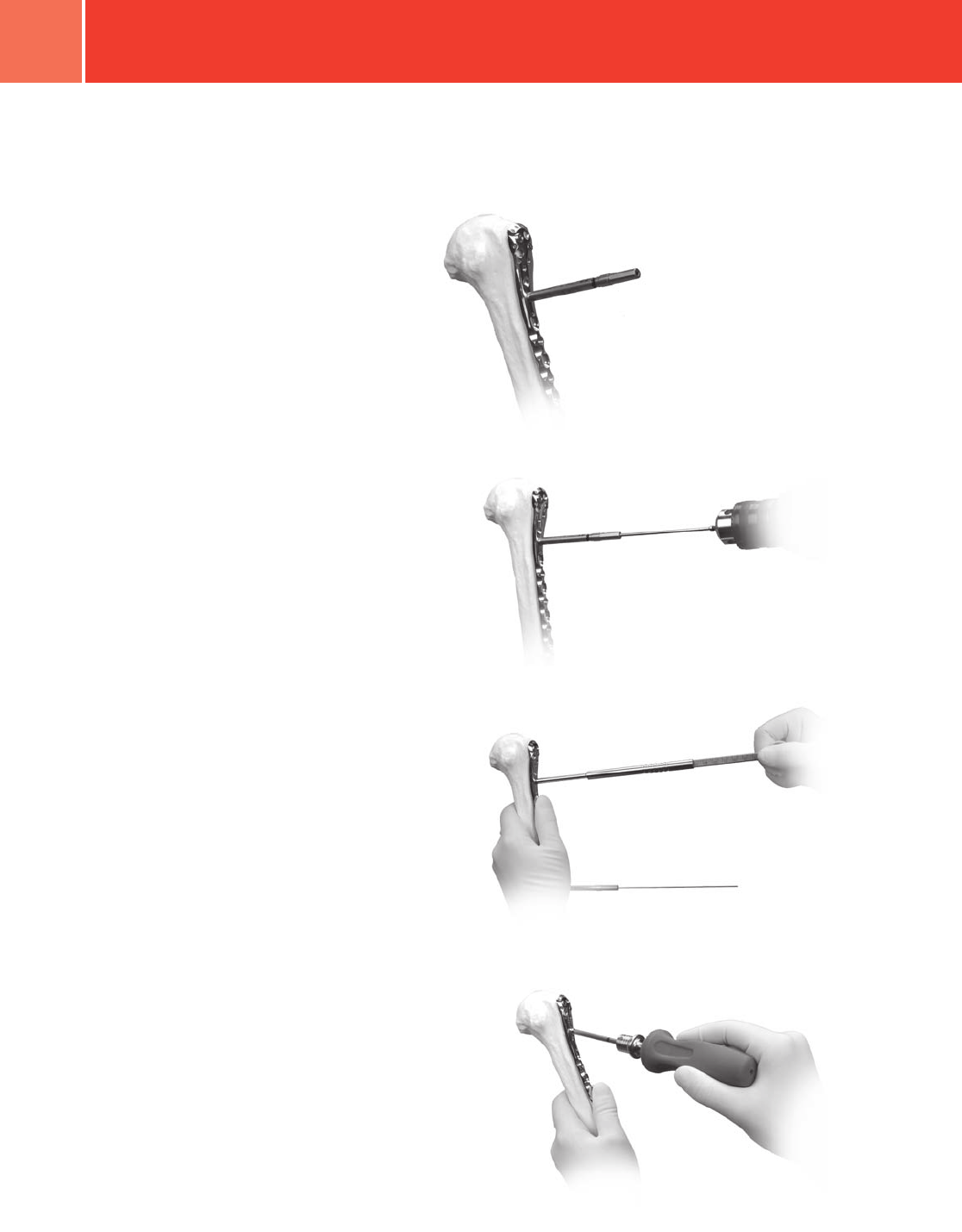 Zimmer Periarticular Proximal Humeral Locking Plate Surgical Technique