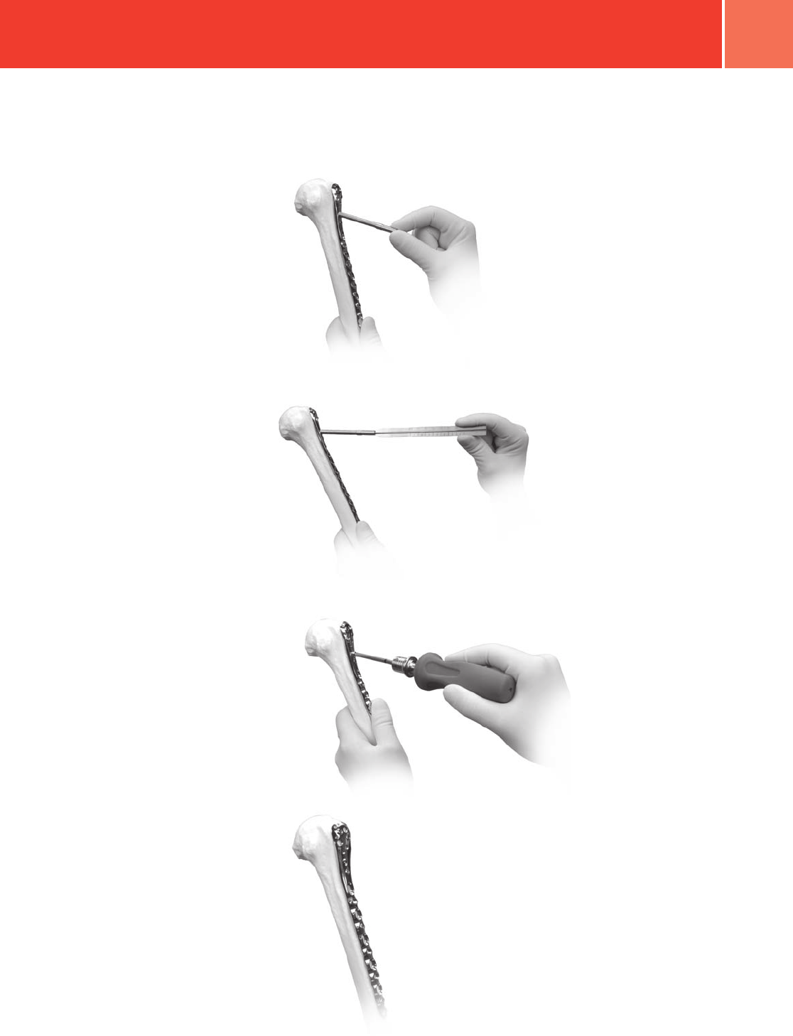 Zimmer Periarticular Proximal Humeral Locking Plate Surgical Technique