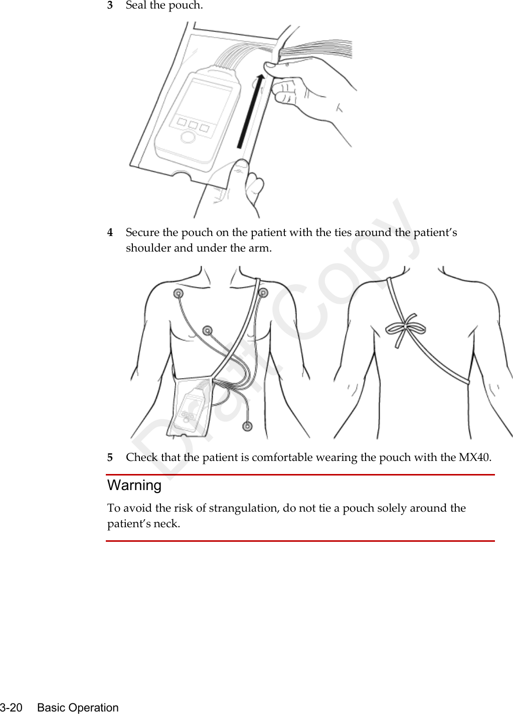    3-20    Basic Operation  3 Seal the pouch.  4 Secure the pouch on the patient with the ties around the patient’s shoulder and under the arm.  5 Check that the patient is comfortable wearing the pouch with the MX40.   Warning To avoid the risk of strangulation, do not tie a pouch solely around the patient’s neck.   Draft Copy