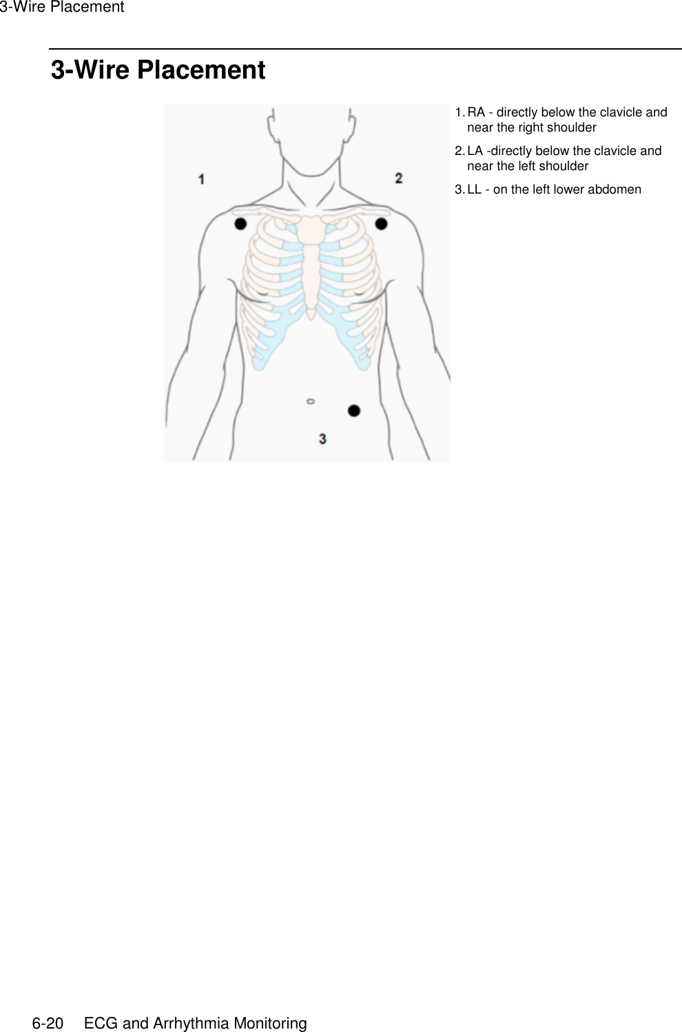 3-Wire Placement   6-20    ECG and Arrhythmia Monitoring 3-Wire Placement  1. RA - directly below the clavicle and near the right shoulder 2. LA -directly below the clavicle and near the left shoulder 3. LL - on the left lower abdomen   