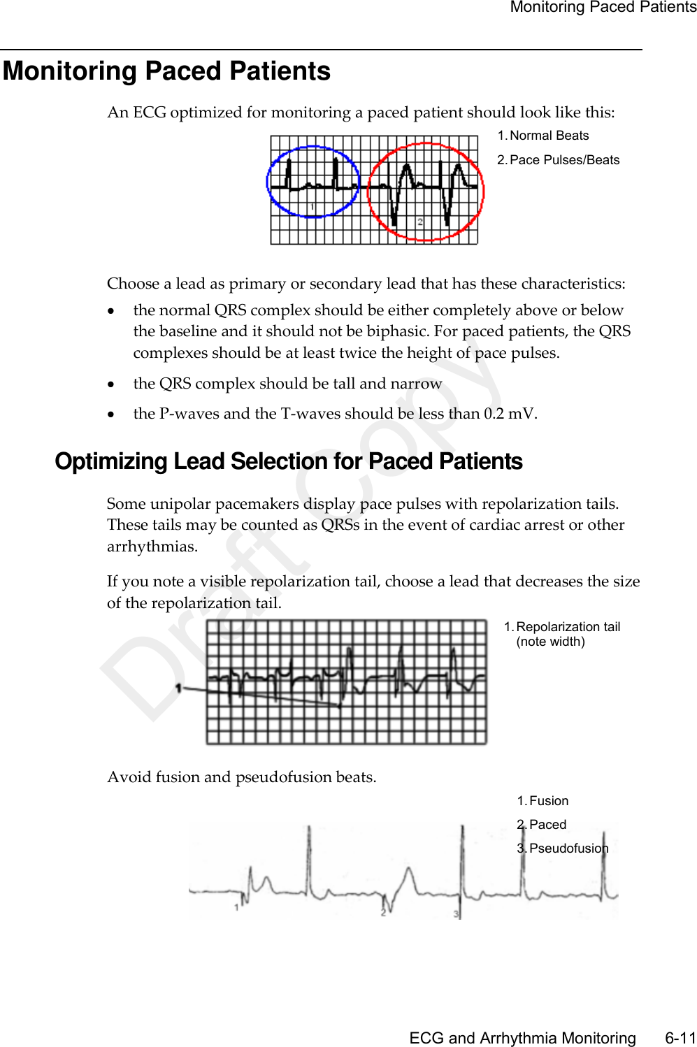     Monitoring Paced Patients       ECG and Arrhythmia Monitoring      6-11 Monitoring Paced Patients An ECG optimized for monitoring a paced patient should look like this:  1. Normal Beats 2. Pace Pulses/Beats Choose a lead as primary or secondary lead that has these characteristics:  the normal QRS complex should be either completely above or below the baseline and it should not be biphasic. For paced patients, the QRS complexes should be at least twice the height of pace pulses.  the QRS complex should be tall and narrow  the P-waves and the T-waves should be less than 0.2 mV.  Optimizing Lead Selection for Paced Patients Some unipolar pacemakers display pace pulses with repolarization tails. These tails may be counted as QRSs in the event of cardiac arrest or other arrhythmias. If you note a visible repolarization tail, choose a lead that decreases the size of the repolarization tail.  1. Repolarization tail (note width) Avoid fusion and pseudofusion beats.  1. Fusion 2. Paced 3. Pseudofusion   Draft Copy