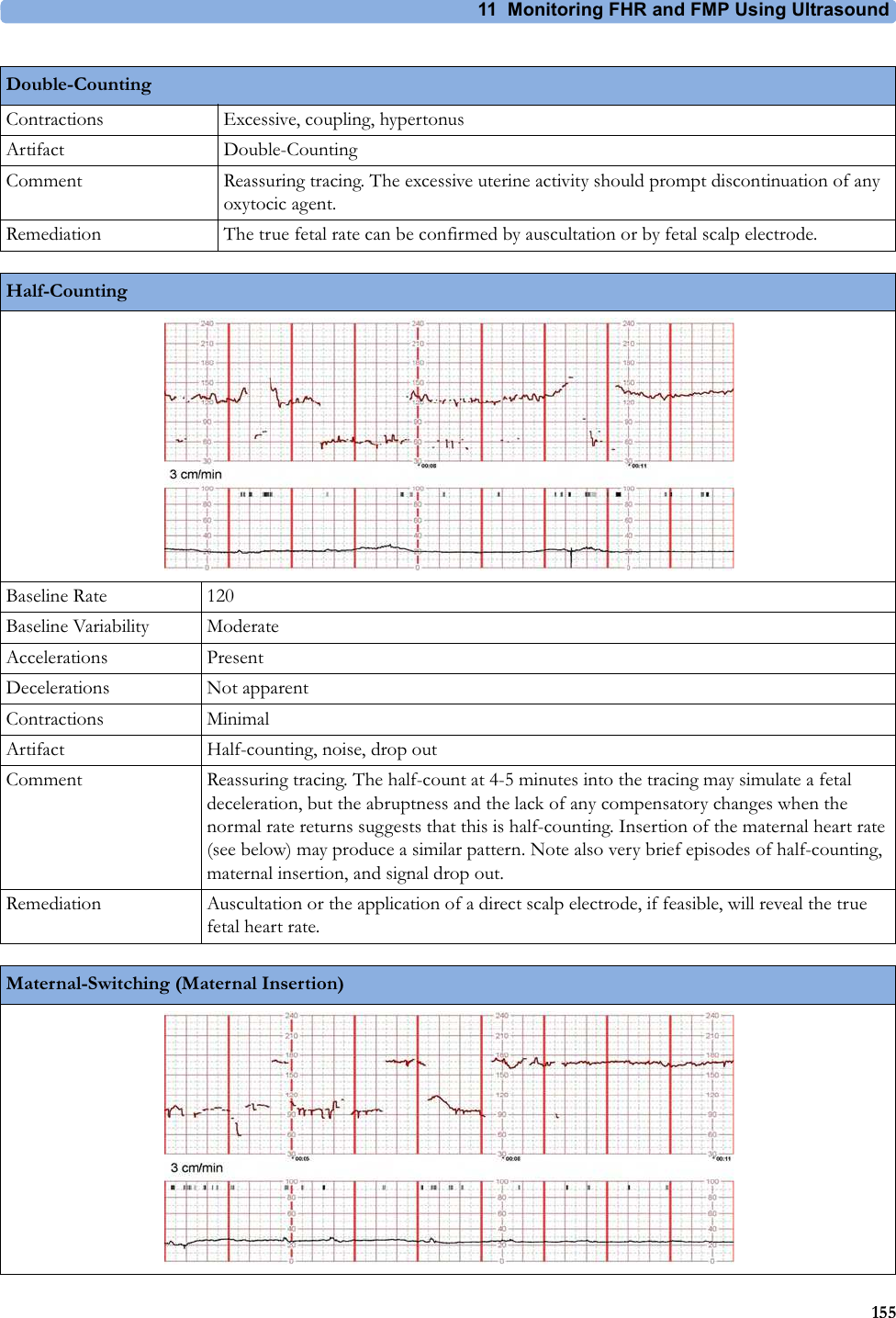 11  Monitoring FHR and FMP Using Ultrasound155Contractions Excessive, coupling, hypertonusArtifact Double-CountingComment Reassuring tracing. The excessive uterine activity should prompt discontinuation of any oxytocic agent.Remediation The true fetal rate can be confirmed by auscultation or by fetal scalp electrode.Double-CountingHalf-CountingBaseline Rate 120Baseline Variability ModerateAccelerations PresentDecelerations Not apparentContractions MinimalArtifact Half-counting, noise, drop outComment Reassuring tracing. The half-count at 4-5 minutes into the tracing may simulate a fetal deceleration, but the abruptness and the lack of any compensatory changes when the normal rate returns suggests that this is half-counting. Insertion of the maternal heart rate (see below) may produce a similar pattern. Note also very brief episodes of half-counting, maternal insertion, and signal drop out.Remediation Auscultation or the application of a direct scalp electrode, if feasible, will reveal the true fetal heart rate.Maternal-Switching (Maternal Insertion)