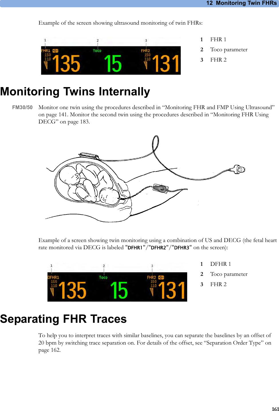 12  Monitoring Twin FHRs161Example of the screen showing ultrasound monitoring of twin FHRs:Monitoring Twins InternallyFM30/50 Monitor one twin using the procedures described in “Monitoring FHR and FMP Using Ultrasound” on page 141. Monitor the second twin using the procedures described in “Monitoring FHR Using DECG” on page 183.Example of a screen showing twin monitoring using a combination of US and DECG (the fetal heart rate monitored via DECG is labeled &quot;DFHR1&quot;/&quot;DFHR2&quot;/&quot;DFHR3&quot; on the screen):Separating FHR TracesTo help you to interpret traces with similar baselines, you can separate the baselines by an offset of 20 bpm by switching trace separation on. For details of the offset, see “Separation Order Type” on page 162.1FHR 12Toco parameter3FHR 21DFHR 12Toco parameter3FHR 2