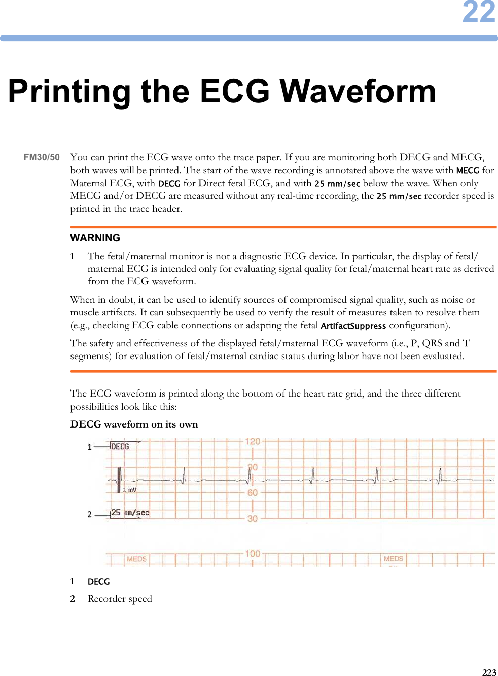 2222322Printing the ECG WaveformFM30/50 You can print the ECG wave onto the trace paper. If you are monitoring both DECG and MECG, both waves will be printed. The start of the wave recording is annotated above the wave with MECG for Maternal ECG, with DECG for Direct fetal ECG, and with 25 mm/sec below the wave. When only MECG and/or DECG are measured without any real-time recording, the 25 mm/sec recorder speed is printed in the trace header.WARNING1The fetal/maternal monitor is not a diagnostic ECG device. In particular, the display of fetal/maternal ECG is intended only for evaluating signal quality for fetal/maternal heart rate as derived from the ECG waveform.When in doubt, it can be used to identify sources of compromised signal quality, such as noise or muscle artifacts. It can subsequently be used to verify the result of measures taken to resolve them (e.g., checking ECG cable connections or adapting the fetal ArtifactSuppress configuration).The safety and effectiveness of the displayed fetal/maternal ECG waveform (i.e., P, QRS and T segments) for evaluation of fetal/maternal cardiac status during labor have not been evaluated.The ECG waveform is printed along the bottom of the heart rate grid, and the three different possibilities look like this:DECG waveform on its own1DECG2Recorder speed