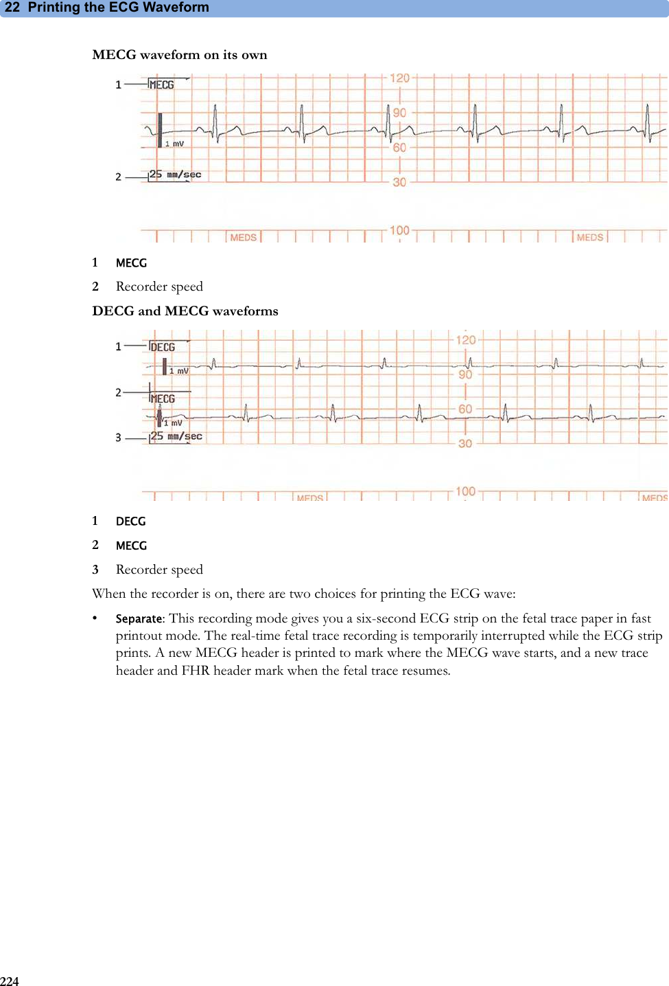 22  Printing the ECG Waveform224MECG waveform on its own1MECG2Recorder speedDECG and MECG waveforms1DECG2MECG3Recorder speedWhen the recorder is on, there are two choices for printing the ECG wave:•Separate: This recording mode gives you a six-second ECG strip on the fetal trace paper in fast printout mode. The real-time fetal trace recording is temporarily interrupted while the ECG strip prints. A new MECG header is printed to mark where the MECG wave starts, and a new trace header and FHR header mark when the fetal trace resumes.