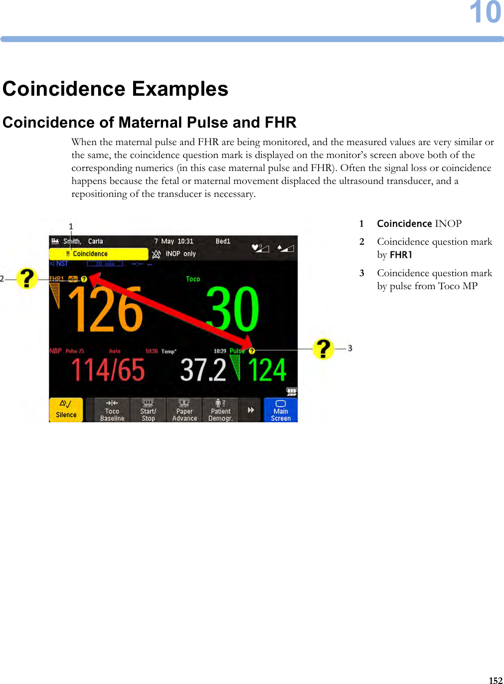 10152Coincidence ExamplesCoincidence of Maternal Pulse and FHRWhen the maternal pulse and FHR are being monitored, and the measured values are very similar or the same, the coincidence question mark is displayed on the monitor’s screen above both of the corresponding numerics (in this case maternal pulse and FHR). Often the signal loss or coincidence happens because the fetal or maternal movement displaced the ultrasound transducer, and a repositioning of the transducer is necessary.1Coincidence INOP2Coincidence question mark by FHR13Coincidence question mark by pulse from Toco MP