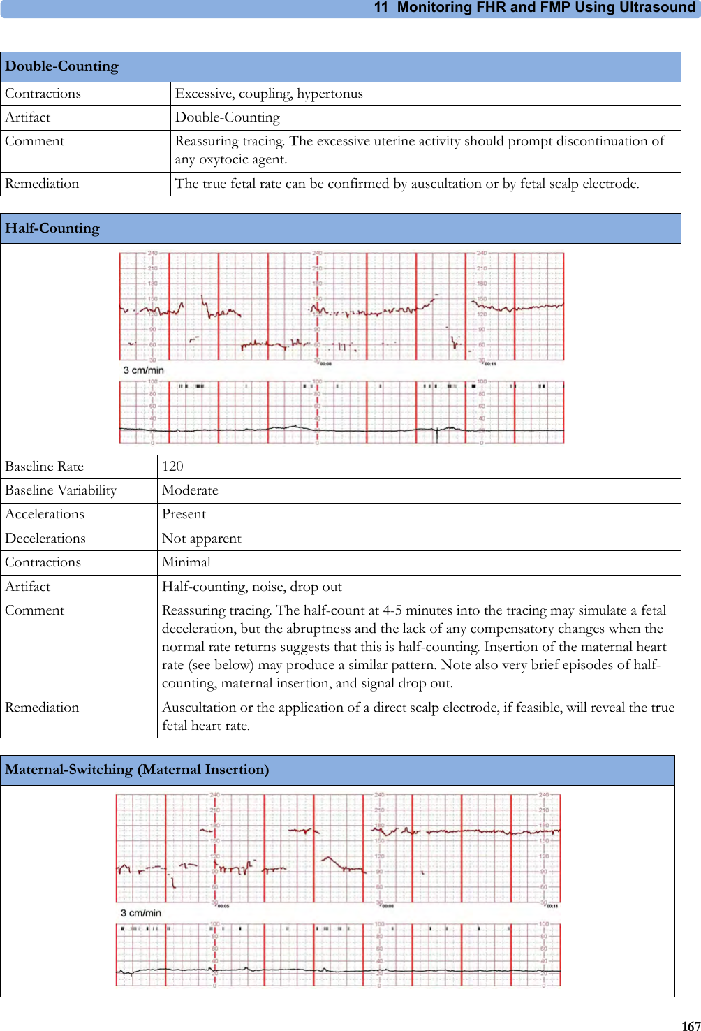 11 Monitoring FHR and FMP Using Ultrasound167Contractions Excessive, coupling, hypertonusArtifact Double-CountingComment Reassuring tracing. The excessive uterine activity should prompt discontinuation of any oxytocic agent.Remediation The true fetal rate can be confirmed by auscultation or by fetal scalp electrode.Double-CountingHalf-CountingBaseline Rate 120Baseline Variability ModerateAccelerations PresentDecelerations Not apparentContractions MinimalArtifact Half-counting, noise, drop outComment Reassuring tracing. The half-count at 4-5 minutes into the tracing may simulate a fetal deceleration, but the abruptness and the lack of any compensatory changes when the normal rate returns suggests that this is half-counting. Insertion of the maternal heart rate (see below) may produce a similar pattern. Note also very brief episodes of half-counting, maternal insertion, and signal drop out.Remediation Auscultation or the application of a direct scalp electrode, if feasible, will reveal the true fetal heart rate.Maternal-Switching (Maternal Insertion)