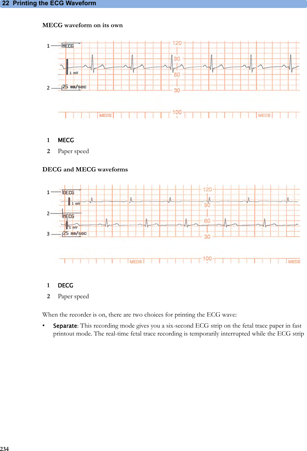 22 Printing the ECG Waveform234MECG waveform on its ownDECG and MECG waveformsWhen the recorder is on, there are two choices for printing the ECG wave:•Separate: This recording mode gives you a six-second ECG strip on the fetal trace paper in fast printout mode. The real-time fetal trace recording is temporarily interrupted while the ECG strip 1MECG2Paper speed1DECG2Paper speed