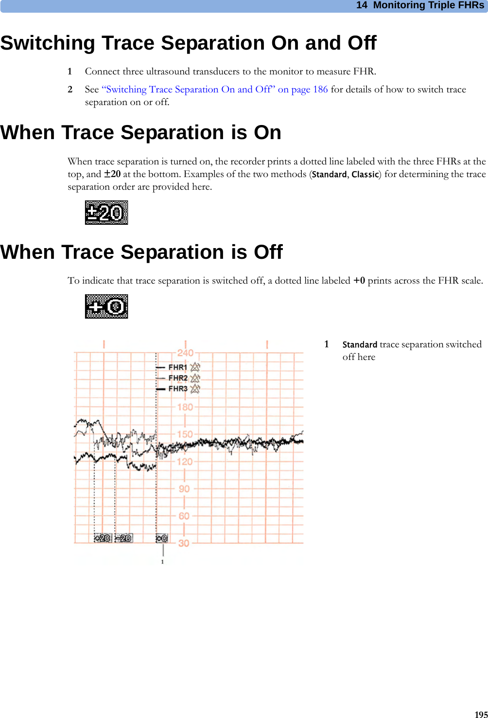 14  Monitoring Triple FHRs195Switching Trace Separation On and Off1Connect three ultrasound transducers to the monitor to measure FHR.2See “Switching Trace Separation On and Off” on page 186 for details of how to switch trace separation on or off.When Trace Separation is OnWhen trace separation is turned on, the recorder prints a dotted line labeled with the three FHRs at the top, and ±20 at the bottom. Examples of the two methods (Standard, Classic) for determining the trace separation order are provided here.When Trace Separation is OffTo indicate that trace separation is switched off, a dotted line labeled +0 prints across the FHR scale.1Standard trace separation switched off here