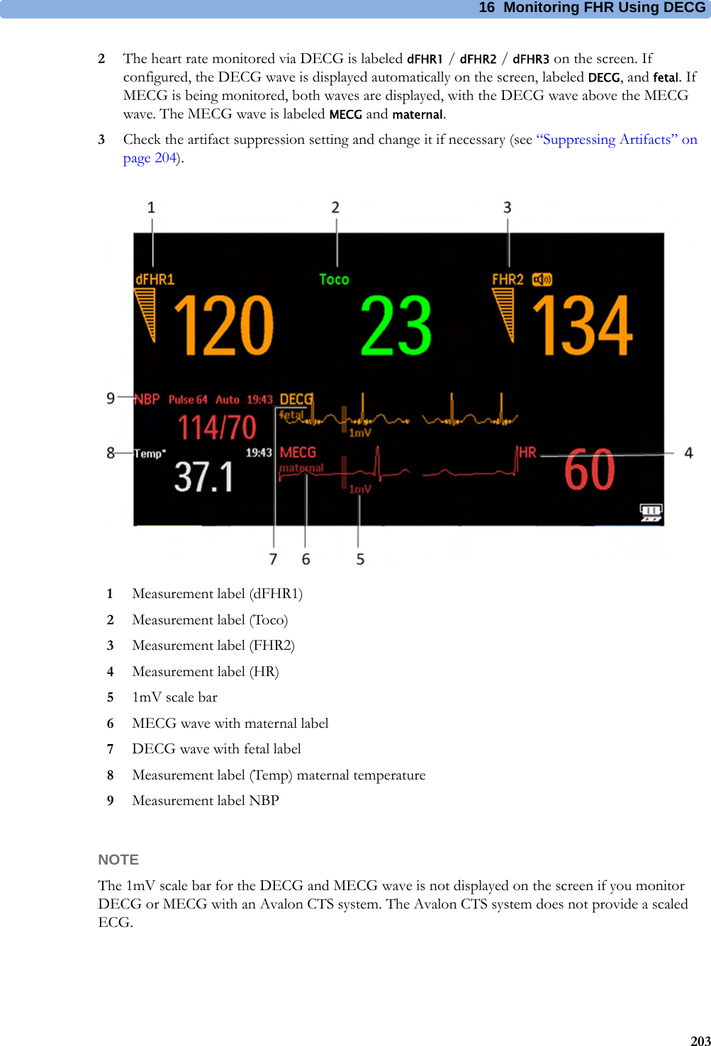 16  Monitoring FHR Using DECG2032The heart rate monitored via DECG is labeled dFHR1 / dFHR2 / dFHR3 on the screen. If configured, the DECG wave is displayed automatically on the screen, labeled DECG, and fetal. If MECG is being monitored, both waves are displayed, with the DECG wave above the MECG wave. The MECG wave is labeled MECG and maternal.3Check the artifact suppression setting and change it if necessary (see “Suppressing Artifacts” on page 204).NOTEThe 1mV scale bar for the DECG and MECG wave is not displayed on the screen if you monitor DECG or MECG with an Avalon CTS system. The Avalon CTS system does not provide a scaled ECG.1Measurement label (dFHR1)2Measurement label (Toco)3Measurement label (FHR2)4Measurement label (HR)51mV scale bar6MECG wave with maternal label7DECG wave with fetal label8Measurement label (Temp) maternal temperature9Measurement label NBP