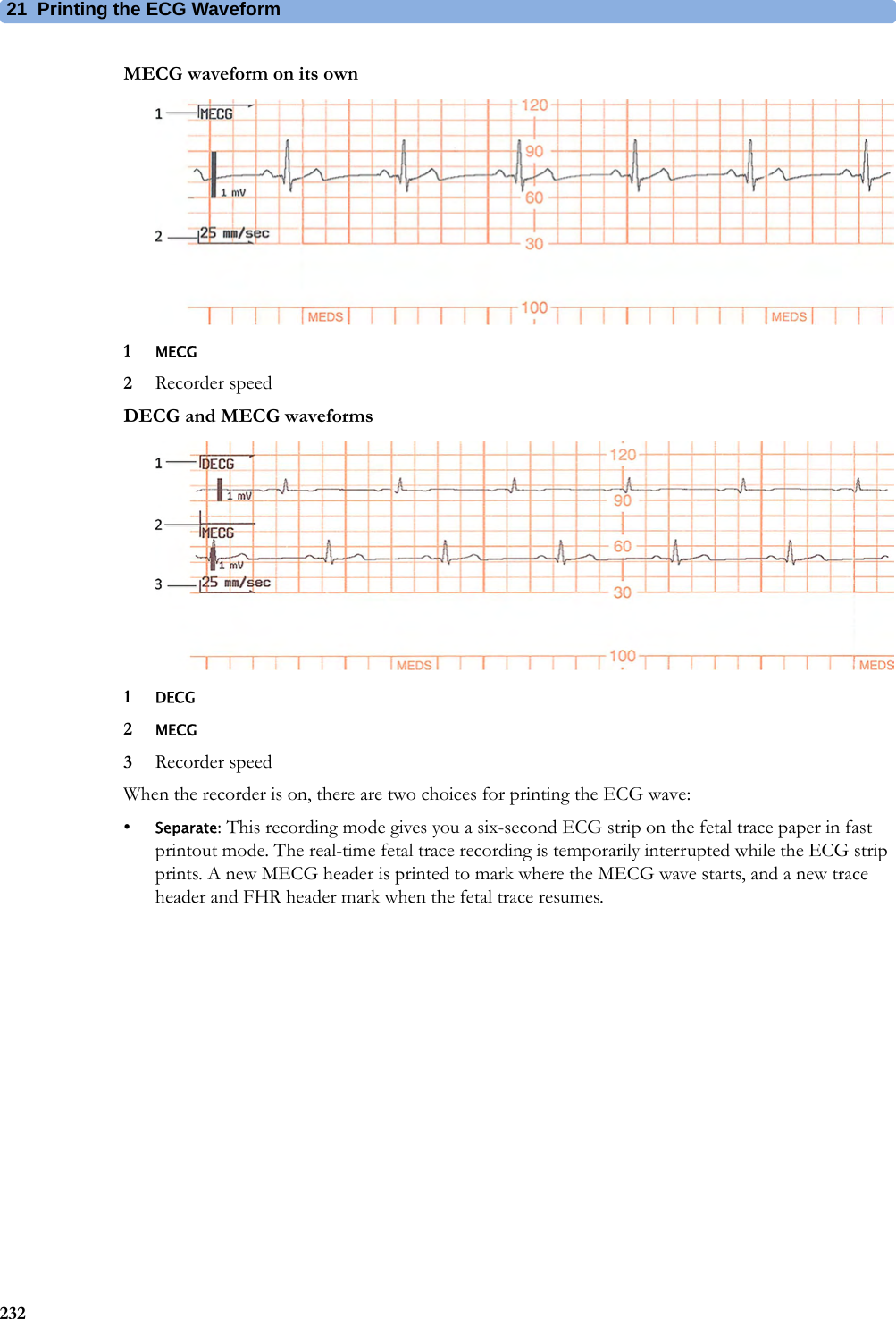 21  Printing the ECG Waveform232MECG waveform on its own1MECG2Recorder speedDECG and MECG waveforms1DECG2MECG3Recorder speedWhen the recorder is on, there are two choices for printing the ECG wave:•Separate: This recording mode gives you a six-second ECG strip on the fetal trace paper in fast printout mode. The real-time fetal trace recording is temporarily interrupted while the ECG strip prints. A new MECG header is printed to mark where the MECG wave starts, and a new trace header and FHR header mark when the fetal trace resumes.