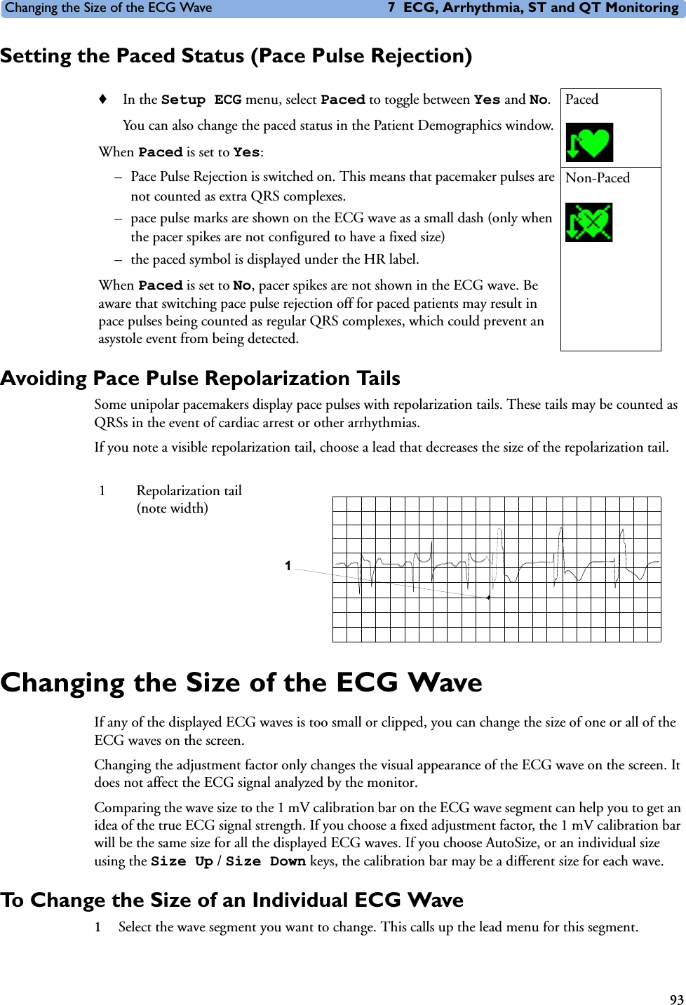 Changing the Size of the ECG Wave 7 ECG, Arrhythmia, ST and QT Monitoring93Setting the Paced Status (Pace Pulse Rejection)Avoiding Pace Pulse Repolarization TailsSome unipolar pacemakers display pace pulses with repolarization tails. These tails may be counted as QRSs in the event of cardiac arrest or other arrhythmias. If you note a visible repolarization tail, choose a lead that decreases the size of the repolarization tail.Changing the Size of the ECG WaveIf any of the displayed ECG waves is too small or clipped, you can change the size of one or all of the ECG waves on the screen.Changing the adjustment factor only changes the visual appearance of the ECG wave on the screen. It does not affect the ECG signal analyzed by the monitor.Comparing the wave size to the 1 mV calibration bar on the ECG wave segment can help you to get an idea of the true ECG signal strength. If you choose a fixed adjustment factor, the 1 mV calibration bar will be the same size for all the displayed ECG waves. If you choose AutoSize, or an individual size using the Size Up / Size Down keys, the calibration bar may be a different size for each wave. To Change the Size of an Individual ECG Wave1Select the wave segment you want to change. This calls up the lead menu for this segment.♦In the Setup ECG menu, select Paced to toggle between Yes and No. You can also change the paced status in the Patient Demographics window. When Paced is set to Yes: – Pace Pulse Rejection is switched on. This means that pacemaker pulses are not counted as extra QRS complexes. – pace pulse marks are shown on the ECG wave as a small dash (only when the pacer spikes are not configured to have a fixed size)– the paced symbol is displayed under the HR label.When Paced is set to No, pacer spikes are not shown in the ECG wave. Be aware that switching pace pulse rejection off for paced patients may result in pace pulses being counted as regular QRS complexes, which could prevent an asystole event from being detected.PacedNon-Paced1 Repolarization tail (note width)1
