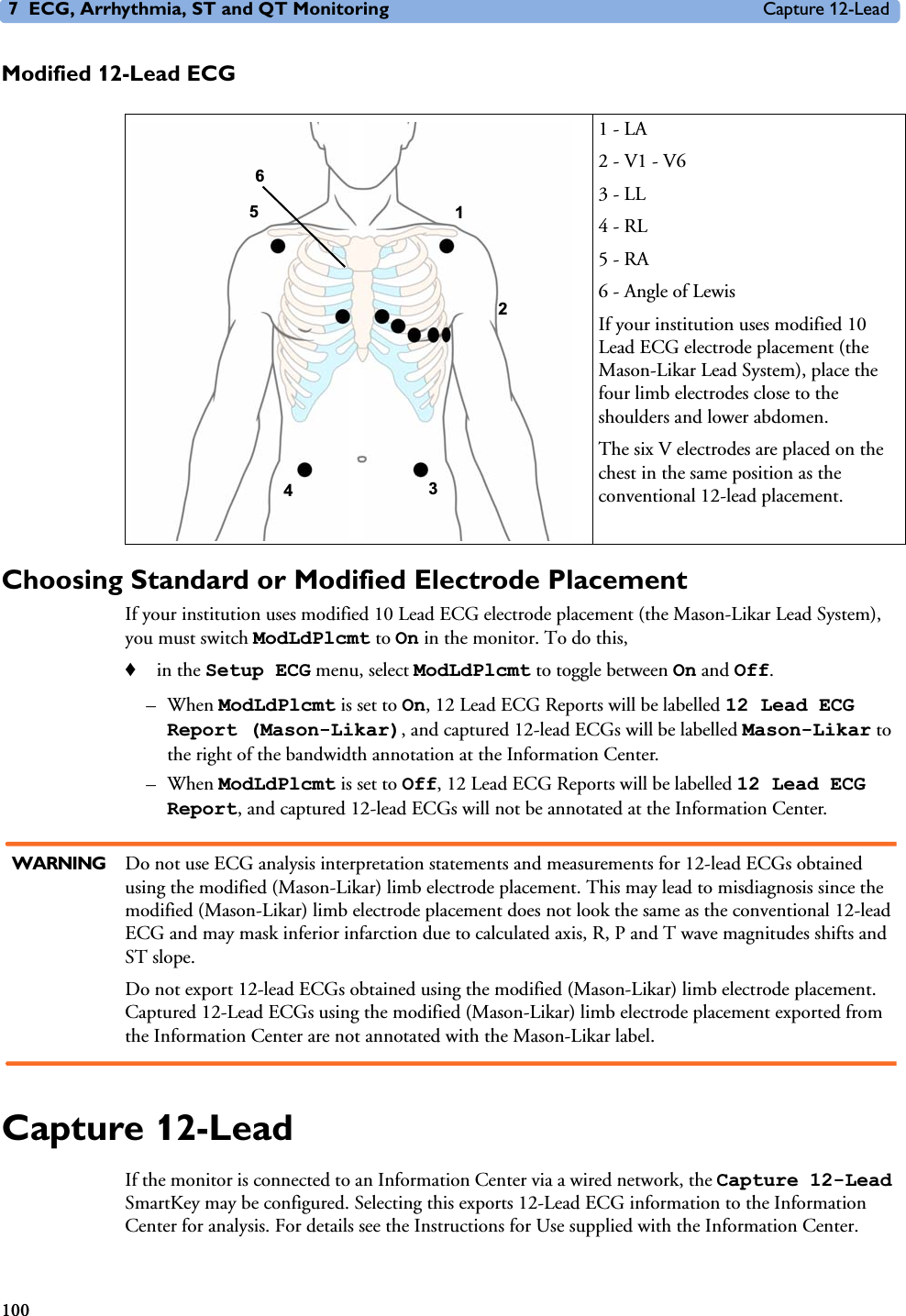 7 ECG, Arrhythmia, ST and QT Monitoring Capture 12-Lead100Modified 12-Lead ECGChoosing Standard or Modified Electrode PlacementIf your institution uses modified 10 Lead ECG electrode placement (the Mason-Likar Lead System), you must switch ModLdPlcmt to On in the monitor. To do this,♦in the Setup ECG menu, select ModLdPlcmt to toggle between On and Off.–When ModLdPlcmt is set to On, 12 Lead ECG Reports will be labelled 12 Lead ECG Report (Mason-Likar), and captured 12-lead ECGs will be labelled Mason-Likar to the right of the bandwidth annotation at the Information Center.–When ModLdPlcmt is set to Off, 12 Lead ECG Reports will be labelled 12 Lead ECG Report, and captured 12-lead ECGs will not be annotated at the Information Center.WARNING Do not use ECG analysis interpretation statements and measurements for 12-lead ECGs obtained using the modified (Mason-Likar) limb electrode placement. This may lead to misdiagnosis since the modified (Mason-Likar) limb electrode placement does not look the same as the conventional 12-lead ECG and may mask inferior infarction due to calculated axis, R, P and T wave magnitudes shifts and ST slope. Do not export 12-lead ECGs obtained using the modified (Mason-Likar) limb electrode placement. Captured 12-Lead ECGs using the modified (Mason-Likar) limb electrode placement exported from the Information Center are not annotated with the Mason-Likar label. Capture 12-LeadIf the monitor is connected to an Information Center via a wired network, the Capture 12-Lead SmartKey may be configured. Selecting this exports 12-Lead ECG information to the Information Center for analysis. For details see the Instructions for Use supplied with the Information Center. 1 - LA2 - V1 - V63 - LL4 - RL5 - RA6 - Angle of LewisIf your institution uses modified 10 Lead ECG electrode placement (the Mason-Likar Lead System), place the four limb electrodes close to the shoulders and lower abdomen.The six V electrodes are placed on the chest in the same position as the conventional 12-lead placement.1 35462