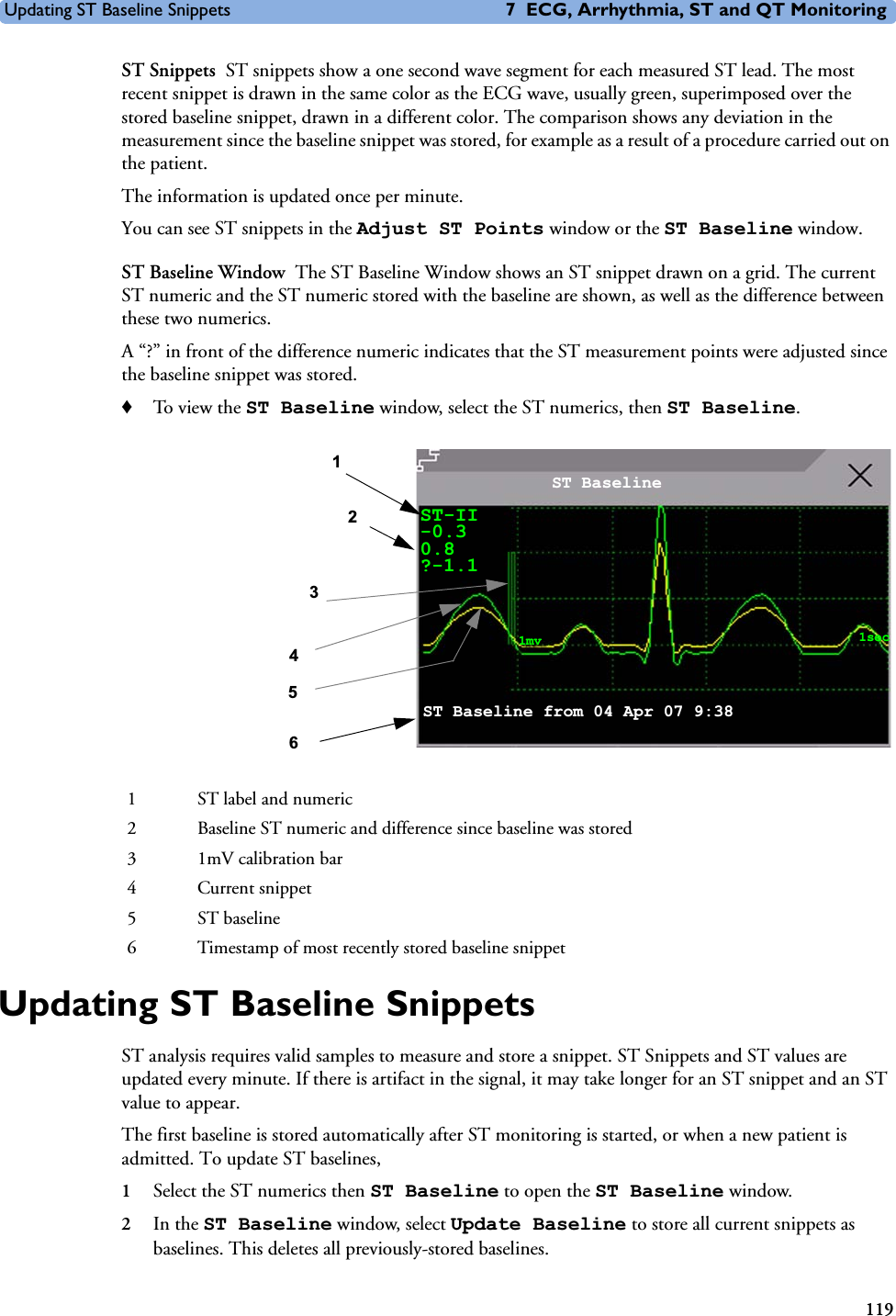 Updating ST Baseline Snippets 7 ECG, Arrhythmia, ST and QT Monitoring119ST Snippets ST snippets show a one second wave segment for each measured ST lead. The most recent snippet is drawn in the same color as the ECG wave, usually green, superimposed over the stored baseline snippet, drawn in a different color. The comparison shows any deviation in the measurement since the baseline snippet was stored, for example as a result of a procedure carried out on the patient.The information is updated once per minute. You can see ST snippets in the Adjust ST Points window or the ST Baseline window. ST Baseline Window The ST Baseline Window shows an ST snippet drawn on a grid. The current ST numeric and the ST numeric stored with the baseline are shown, as well as the difference between these two numerics. A “?” in front of the difference numeric indicates that the ST measurement points were adjusted since the baseline snippet was stored. ♦To vie w th e ST Baseline window, select the ST numerics, then ST Baseline.Updating ST Baseline SnippetsST analysis requires valid samples to measure and store a snippet. ST Snippets and ST values are updated every minute. If there is artifact in the signal, it may take longer for an ST snippet and an ST value to appear. The first baseline is stored automatically after ST monitoring is started, or when a new patient is admitted. To update ST baselines,1Select the ST numerics then ST Baseline to open the ST Baseline window. 2In the ST Baseline window, select Update Baseline to store all current snippets as baselines. This deletes all previously-stored baselines.1 ST label and numeric2 Baseline ST numeric and difference since baseline was stored3 1mV calibration bar4Current snippet5ST baseline6 Timestamp of most recently stored baseline snippet1ST Baseline from 04 Apr 07 9:386 ST Baseline3452ST-II-0.30.8?-1.11mv 1sec