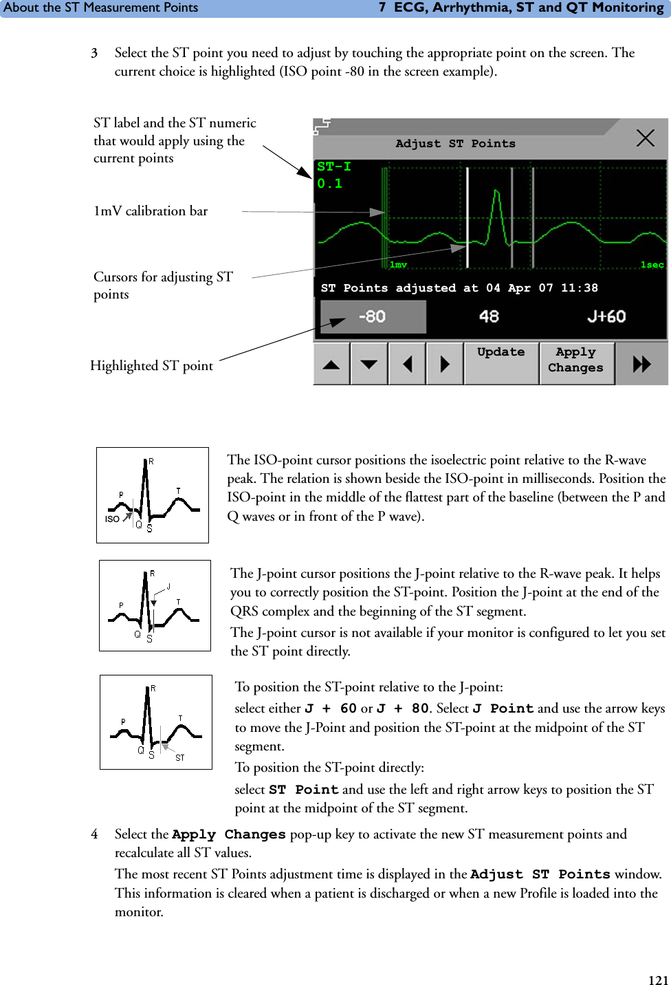 About the ST Measurement Points 7 ECG, Arrhythmia, ST and QT Monitoring1213Select the ST point you need to adjust by touching the appropriate point on the screen. The current choice is highlighted (ISO point -80 in the screen example).The ISO-point cursor positions the isoelectric point relative to the R-wave peak. The relation is shown beside the ISO-point in milliseconds. Position the ISO-point in the middle of the flattest part of the baseline (between the P and Q waves or in front of the P wave). The J-point cursor positions the J-point relative to the R-wave peak. It helps you to correctly position the ST-point. Position the J-point at the end of the QRS complex and the beginning of the ST segment. The J-point cursor is not available if your monitor is configured to let you set the ST point directly. To position the ST-point relative to the J-point:select either J+60 or J+80. Select J Point and use the arrow keys to move the J-Point and position the ST-point at the midpoint of the ST segment. To position the ST-point directly: select ST Point and use the left and right arrow keys to position the ST point at the midpoint of the ST segment.4Select the Apply Changes pop-up key to activate the new ST measurement points and recalculate all ST values.The most recent ST Points adjustment time is displayed in the Adjust ST Points window. This information is cleared when a patient is discharged or when a new Profile is loaded into the monitor. 1mV calibration barHighlighted ST pointST label and the ST numeric that would apply using the current pointsCursors for adjusting ST pointsAdjust ST PointsST-I0.1Update Apply Changes1mv 1secST Points adjusted at 04 Apr 07 11:38ISO