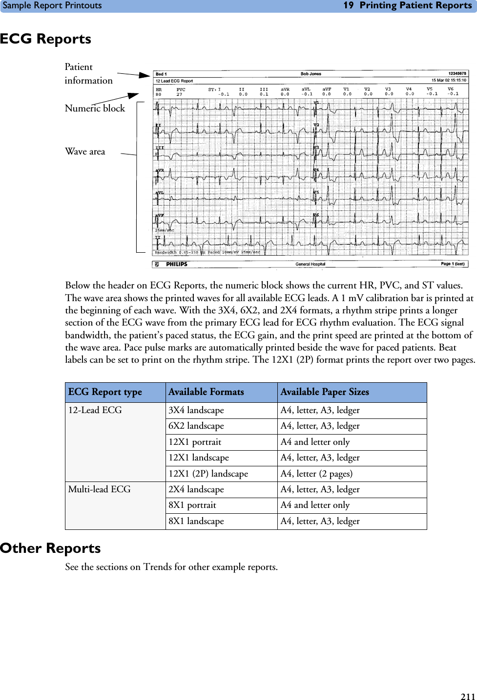 Sample Report Printouts 19 Printing Patient Reports211ECG ReportsBelow the header on ECG Reports, the numeric block shows the current HR, PVC, and ST values. The wave area shows the printed waves for all available ECG leads. A 1 mV calibration bar is printed at the beginning of each wave. With the 3X4, 6X2, and 2X4 formats, a rhythm stripe prints a longer section of the ECG wave from the primary ECG lead for ECG rhythm evaluation. The ECG signal bandwidth, the patient’s paced status, the ECG gain, and the print speed are printed at the bottom of the wave area. Pace pulse marks are automatically printed beside the wave for paced patients. Beat labels can be set to print on the rhythm stripe. The 12X1 (2P) format prints the report over two pages.Other ReportsSee the sections on Trends for other example reports.ECG Report type Available Formats Available Paper Sizes12-Lead ECG 3X4 landscape A4, letter, A3, ledger6X2 landscape A4, letter, A3, ledger12X1 portrait A4 and letter only12X1 landscape A4, letter, A3, ledger12X1 (2P) landscape A4, letter (2 pages)Multi-lead ECG 2X4 landscape A4, letter, A3, ledger8X1 portrait A4 and letter only8X1 landscape A4, letter, A3, ledgerPatient informationNumeric blockWave area