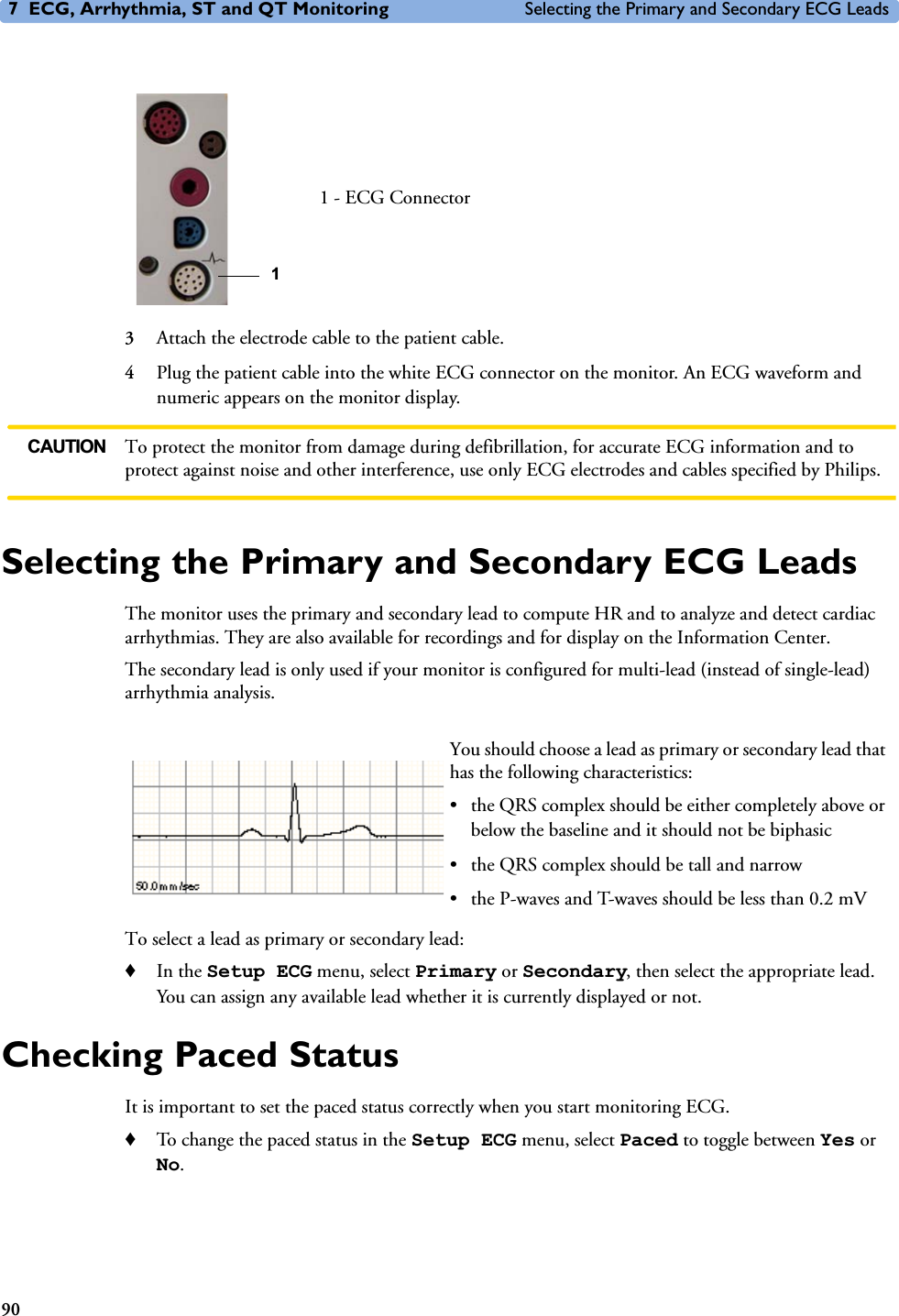 7 ECG, Arrhythmia, ST and QT Monitoring Selecting the Primary and Secondary ECG Leads903Attach the electrode cable to the patient cable.4Plug the patient cable into the white ECG connector on the monitor. An ECG waveform and numeric appears on the monitor display. CAUTION To protect the monitor from damage during defibrillation, for accurate ECG information and to protect against noise and other interference, use only ECG electrodes and cables specified by Philips. Selecting the Primary and Secondary ECG LeadsThe monitor uses the primary and secondary lead to compute HR and to analyze and detect cardiac arrhythmias. They are also available for recordings and for display on the Information Center.The secondary lead is only used if your monitor is configured for multi-lead (instead of single-lead) arrhythmia analysis. To select a lead as primary or secondary lead:♦In the Setup ECG menu, select Primary or Secondary, then select the appropriate lead. You can assign any available lead whether it is currently displayed or not.Checking Paced StatusIt is important to set the paced status correctly when you start monitoring ECG. ♦To change the paced status in the Setup ECG menu, select Paced to toggle between Yes or No.1 - ECG Connector1You should choose a lead as primary or secondary lead that has the following characteristics: • the QRS complex should be either completely above or below the baseline and it should not be biphasic• the QRS complex should be tall and narrow• the P-waves and T-waves should be less than 0.2 mV