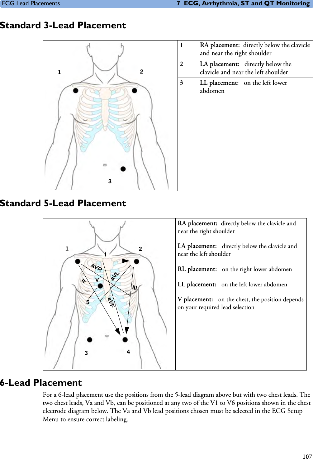 ECG Lead Placements 7 ECG, Arrhythmia, ST and QT Monitoring107Standard 3-Lead PlacementStandard 5-Lead Placement6-Lead PlacementFor a 6-lead placement use the positions from the 5-lead diagram above but with two chest leads. The two chest leads, Va and Vb, can be positioned at any two of the V1 to V6 positions shown in the chest electrode diagram below. The Va and Vb lead positions chosen must be selected in the ECG Setup Menu to ensure correct labeling. 1 RA placement: directly below the clavicle and near the right shoulder2 LA placement:  directly below the clavicle and near the left shoulder3 LL placement:  on the left lower abdomen123RA placement: directly below the clavicle and near the right shoulderLA placement:  directly below the clavicle and near the left shoulderRL placement:  on the right lower abdomenLL placement:  on the left lower abdomenV placement:  on the chest, the position depends on your required lead selection2 4 1V 3 IIIIIIaVRaVLaVF5