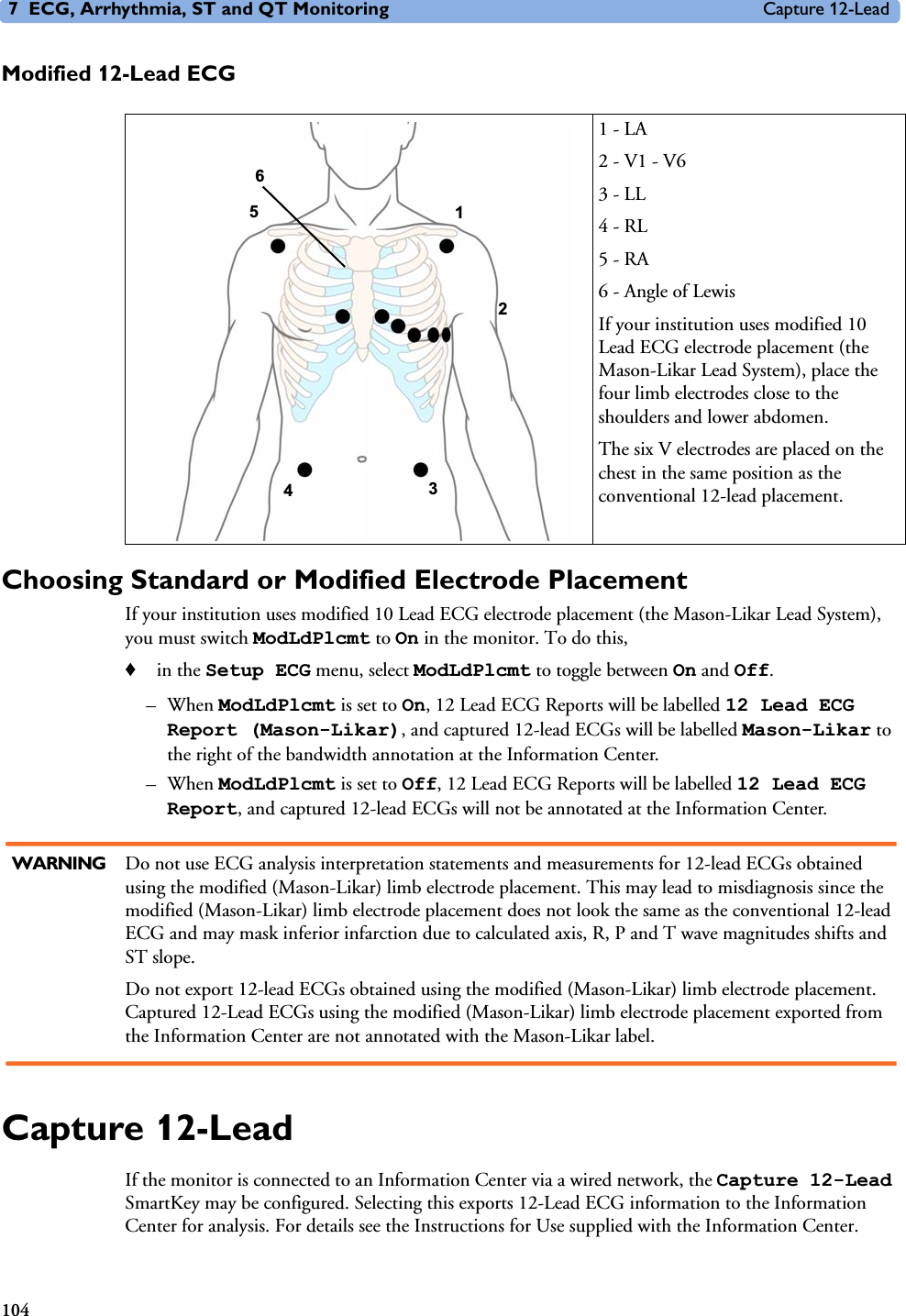 7 ECG, Arrhythmia, ST and QT Monitoring Capture 12-Lead104Modified 12-Lead ECGChoosing Standard or Modified Electrode PlacementIf your institution uses modified 10 Lead ECG electrode placement (the Mason-Likar Lead System), you must switch ModLdPlcmt to On in the monitor. To do this,♦in the Setup ECG menu, select ModLdPlcmt to toggle between On and Off.–When ModLdPlcmt is set to On, 12 Lead ECG Reports will be labelled 12 Lead ECG Report (Mason-Likar), and captured 12-lead ECGs will be labelled Mason-Likar to the right of the bandwidth annotation at the Information Center.–When ModLdPlcmt is set to Off, 12 Lead ECG Reports will be labelled 12 Lead ECG Report, and captured 12-lead ECGs will not be annotated at the Information Center.WARNING Do not use ECG analysis interpretation statements and measurements for 12-lead ECGs obtained using the modified (Mason-Likar) limb electrode placement. This may lead to misdiagnosis since the modified (Mason-Likar) limb electrode placement does not look the same as the conventional 12-lead ECG and may mask inferior infarction due to calculated axis, R, P and T wave magnitudes shifts and ST slope. Do not export 12-lead ECGs obtained using the modified (Mason-Likar) limb electrode placement. Captured 12-Lead ECGs using the modified (Mason-Likar) limb electrode placement exported from the Information Center are not annotated with the Mason-Likar label. Capture 12-LeadIf the monitor is connected to an Information Center via a wired network, the Capture 12-Lead SmartKey may be configured. Selecting this exports 12-Lead ECG information to the Information Center for analysis. For details see the Instructions for Use supplied with the Information Center. 1 - LA2 - V1 - V63 - LL4 - RL5 - RA6 - Angle of LewisIf your institution uses modified 10 Lead ECG electrode placement (the Mason-Likar Lead System), place the four limb electrodes close to the shoulders and lower abdomen.The six V electrodes are placed on the chest in the same position as the conventional 12-lead placement.1 35462