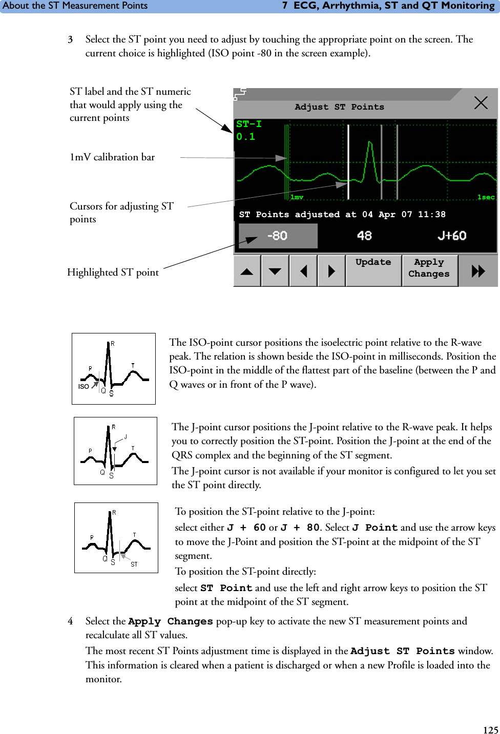 About the ST Measurement Points 7 ECG, Arrhythmia, ST and QT Monitoring1253Select the ST point you need to adjust by touching the appropriate point on the screen. The current choice is highlighted (ISO point -80 in the screen example).The ISO-point cursor positions the isoelectric point relative to the R-wave peak. The relation is shown beside the ISO-point in milliseconds. Position the ISO-point in the middle of the flattest part of the baseline (between the P and Q waves or in front of the P wave). The J-point cursor positions the J-point relative to the R-wave peak. It helps you to correctly position the ST-point. Position the J-point at the end of the QRS complex and the beginning of the ST segment. The J-point cursor is not available if your monitor is configured to let you set the ST point directly. To position the ST-point relative to the J-point:select either J+60 or J+80. Select J Point and use the arrow keys to move the J-Point and position the ST-point at the midpoint of the ST segment. To position the ST-point directly: select ST Point and use the left and right arrow keys to position the ST point at the midpoint of the ST segment.4Select the Apply Changes pop-up key to activate the new ST measurement points and recalculate all ST values.The most recent ST Points adjustment time is displayed in the Adjust ST Points window. This information is cleared when a patient is discharged or when a new Profile is loaded into the monitor. 1mV calibration barHighlighted ST pointST label and the ST numeric that would apply using the current pointsCursors for adjusting ST pointsAdjust ST PointsST-I0.1Update Apply Changes1mv 1secST Points adjusted at 04 Apr 07 11:38ISO
