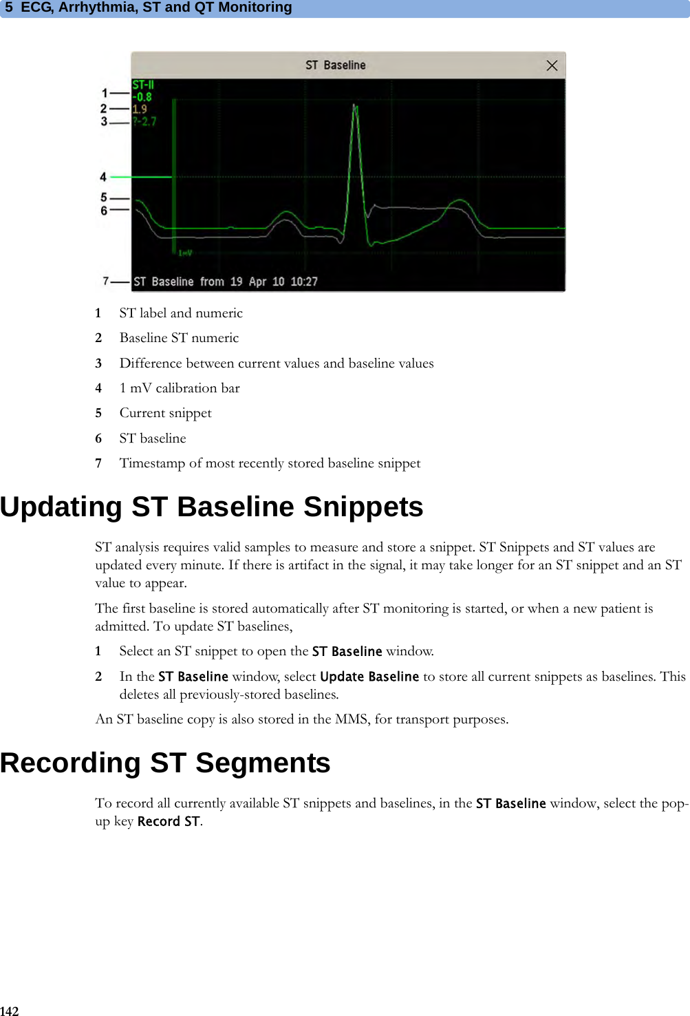 5 ECG, Arrhythmia, ST and QT Monitoring1421ST label and numeric2Baseline ST numeric3Difference between current values and baseline values41 mV calibration bar5Current snippet6ST baseline7Timestamp of most recently stored baseline snippetUpdating ST Baseline SnippetsST analysis requires valid samples to measure and store a snippet. ST Snippets and ST values are updated every minute. If there is artifact in the signal, it may take longer for an ST snippet and an ST value to appear.The first baseline is stored automatically after ST monitoring is started, or when a new patient is admitted. To update ST baselines,1Select an ST snippet to open the ST Baseline window.2In the ST Baseline window, select Update Baseline to store all current snippets as baselines. This deletes all previously-stored baselines.An ST baseline copy is also stored in the MMS, for transport purposes.Recording ST SegmentsTo record all currently available ST snippets and baselines, in the ST Baseline window, select the pop-up key Record ST.