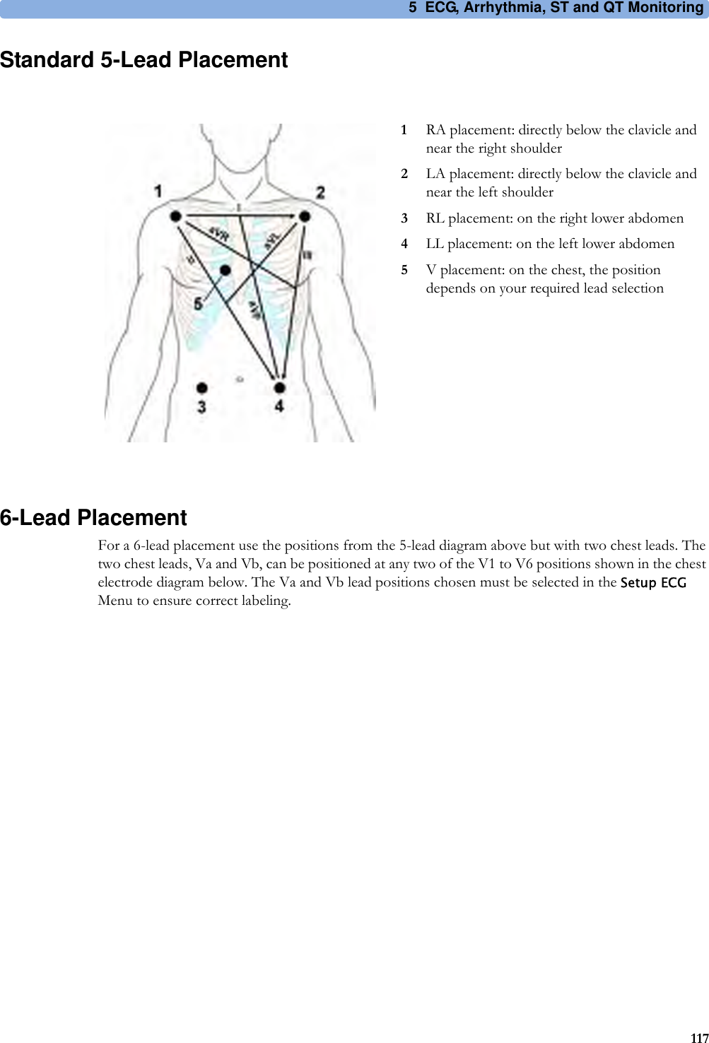5 ECG, Arrhythmia, ST and QT Monitoring117Standard 5-Lead Placement6-Lead PlacementFor a 6-lead placement use the positions from the 5-lead diagram above but with two chest leads. The two chest leads, Va and Vb, can be positioned at any two of the V1 to V6 positions shown in the chest electrode diagram below. The Va and Vb lead positions chosen must be selected in the Setup ECG Menu to ensure correct labeling.1RA placement: directly below the clavicle and near the right shoulder2LA placement: directly below the clavicle and near the left shoulder3RL placement: on the right lower abdomen4LL placement: on the left lower abdomen5V placement: on the chest, the position depends on your required lead selection