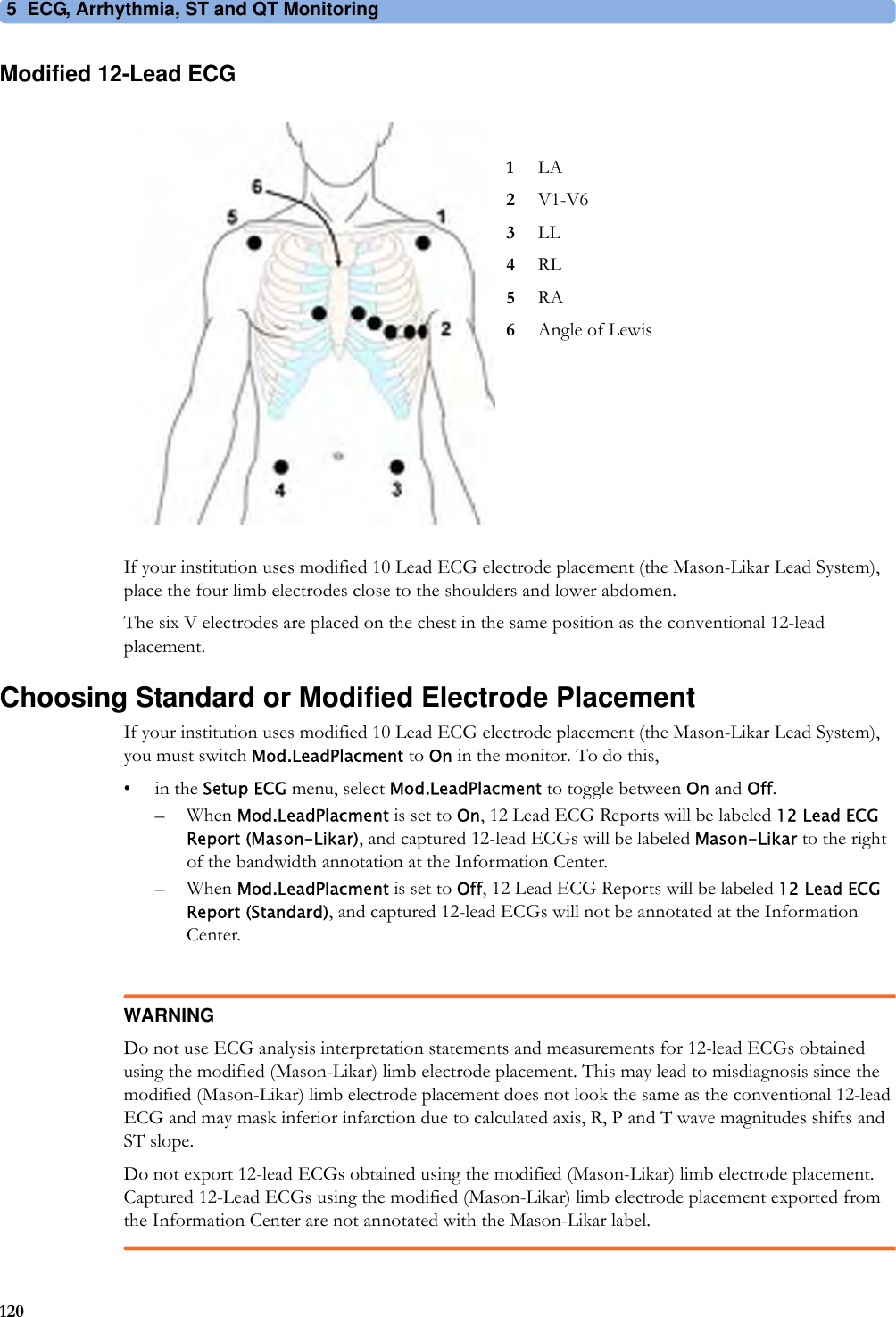 5 ECG, Arrhythmia, ST and QT Monitoring120Modified 12-Lead ECGIf your institution uses modified 10 Lead ECG electrode placement (the Mason-Likar Lead System), place the four limb electrodes close to the shoulders and lower abdomen.The six V electrodes are placed on the chest in the same position as the conventional 12-lead placement.Choosing Standard or Modified Electrode PlacementIf your institution uses modified 10 Lead ECG electrode placement (the Mason-Likar Lead System), you must switch Mod.LeadPlacment to On in the monitor. To do this,•in the Setup ECG menu, select Mod.LeadPlacment to toggle between On and Off.– When Mod.LeadPlacment is set to On, 12 Lead ECG Reports will be labeled 12 Lead ECG Report (Mason-Likar), and captured 12-lead ECGs will be labeled Mason-Likar to the right of the bandwidth annotation at the Information Center.– When Mod.LeadPlacment is set to Off, 12 Lead ECG Reports will be labeled 12 Lead ECG Report (Standard), and captured 12-lead ECGs will not be annotated at the Information Center.WARNINGDo not use ECG analysis interpretation statements and measurements for 12-lead ECGs obtained using the modified (Mason-Likar) limb electrode placement. This may lead to misdiagnosis since the modified (Mason-Likar) limb electrode placement does not look the same as the conventional 12-lead ECG and may mask inferior infarction due to calculated axis, R, P and T wave magnitudes shifts and ST slope.Do not export 12-lead ECGs obtained using the modified (Mason-Likar) limb electrode placement. Captured 12-Lead ECGs using the modified (Mason-Likar) limb electrode placement exported from the Information Center are not annotated with the Mason-Likar label.1LA2V1-V63LL4RL5RA6Angle of Lewis