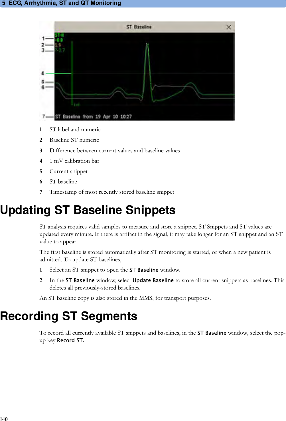 5 ECG, Arrhythmia, ST and QT Monitoring1401ST label and numeric2Baseline ST numeric3Difference between current values and baseline values41 mV calibration bar5Current snippet6ST baseline7Timestamp of most recently stored baseline snippetUpdating ST Baseline SnippetsST analysis requires valid samples to measure and store a snippet. ST Snippets and ST values are updated every minute. If there is artifact in the signal, it may take longer for an ST snippet and an ST value to appear.The first baseline is stored automatically after ST monitoring is started, or when a new patient is admitted. To update ST baselines,1Select an ST snippet to open the ST Baseline window.2In the ST Baseline window, select Update Baseline to store all current snippets as baselines. This deletes all previously-stored baselines.An ST baseline copy is also stored in the MMS, for transport purposes.Recording ST SegmentsTo record all currently available ST snippets and baselines, in the ST Baseline window, select the pop-up key Record ST.