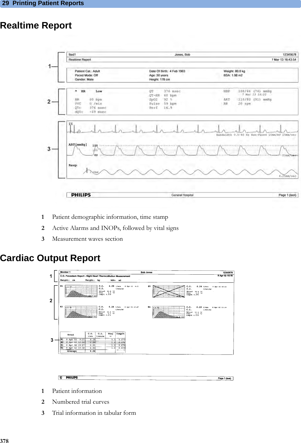 29 Printing Patient Reports378Realtime Report1Patient demographic information, time stamp2Active Alarms and INOPs, followed by vital signs3Measurement waves sectionCardiac Output Report1Patient information2Numbered trial curves3Trial information in tabular form