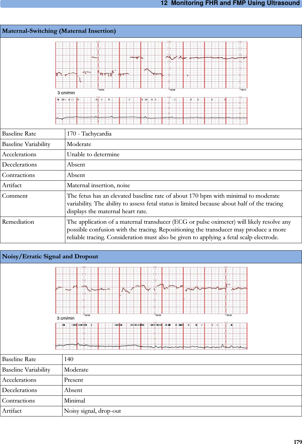 12  Monitoring FHR and FMP Using Ultrasound179Maternal-Switching (Maternal Insertion)Baseline Rate 170 - TachycardiaBaseline Variability ModerateAccelerations Unable to determineDecelerations AbsentContractions AbsentArtifact Maternal insertion, noiseComment The fetus has an elevated baseline rate of about 170 bpm with minimal to moderate variability. The ability to assess fetal status is limited because about half of the tracing displays the maternal heart rate.Remediation The application of a maternal transducer (ECG or pulse oximeter) will likely resolve any possible confusion with the tracing. Repositioning the transducer may produce a more reliable tracing. Consideration must also be given to applying a fetal scalp electrode.Noisy/Erratic Signal and DropoutBaseline Rate 140Baseline Variability ModerateAccelerations PresentDecelerations AbsentContractions MinimalArtifact Noisy signal, drop-out