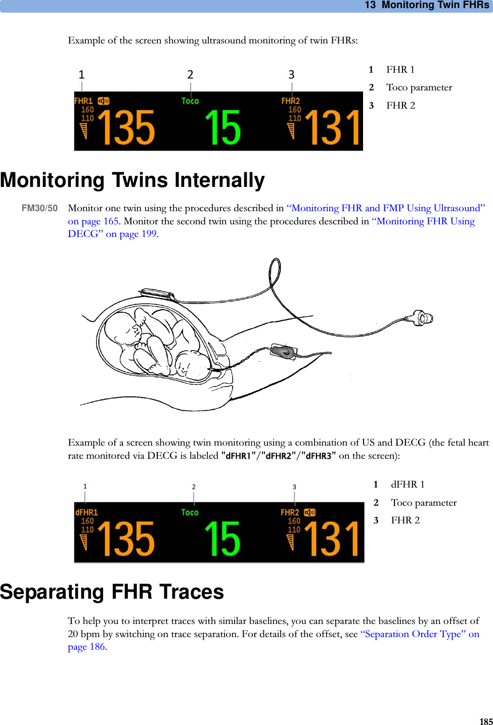 13  Monitoring Twin FHRs185Example of the screen showing ultrasound monitoring of twin FHRs:Monitoring Twins InternallyFM30/50 Monitor one twin using the procedures described in “Monitoring FHR and FMP Using Ultrasound” on page 165. Monitor the second twin using the procedures described in “Monitoring FHR Using DECG” on page 199.Example of a screen showing twin monitoring using a combination of US and DECG (the fetal heart rate monitored via DECG is labeled &quot;dFHR1&quot;/&quot;dFHR2&quot;/&quot;dFHR3&quot; on the screen):Separating FHR TracesTo help you to interpret traces with similar baselines, you can separate the baselines by an offset of 20 bpm by switching on trace separation. For details of the offset, see “Separation Order Type” on page 186.1FHR 12Toco parameter3FHR 21dFHR 12Toco parameter3FHR 2