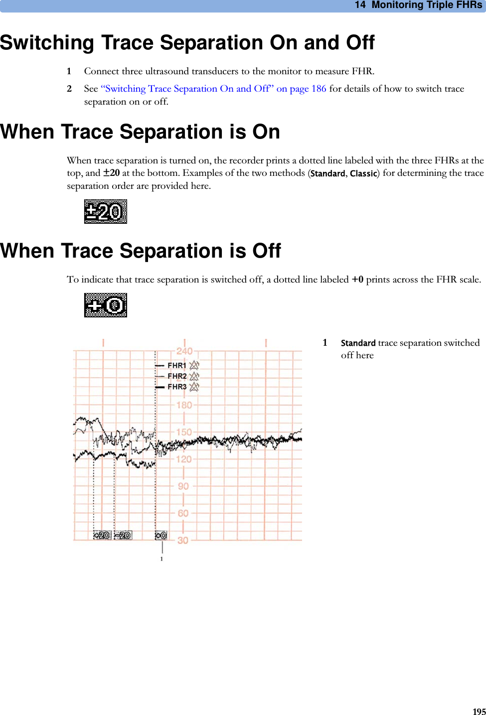 14  Monitoring Triple FHRs195Switching Trace Separation On and Off1Connect three ultrasound transducers to the monitor to measure FHR.2See “Switching Trace Separation On and Off” on page 186 for details of how to switch trace separation on or off.When Trace Separation is OnWhen trace separation is turned on, the recorder prints a dotted line labeled with the three FHRs at the top, and ±20 at the bottom. Examples of the two methods (Standard, Classic) for determining the trace separation order are provided here.When Trace Separation is OffTo indicate that trace separation is switched off, a dotted line labeled +0 prints across the FHR scale.1Standard trace separation switched off here