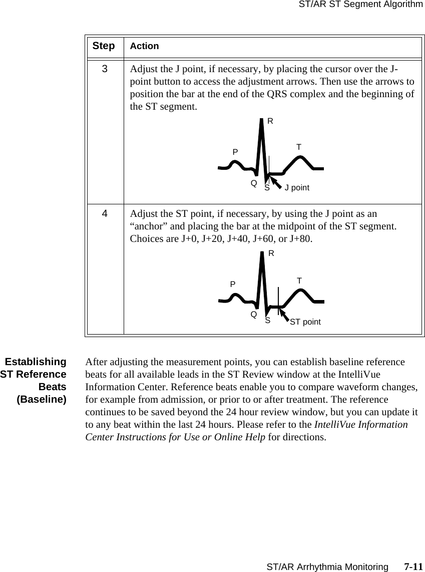 ST/AR ST Segment AlgorithmST/AR Arrhythmia Monitoring      7-11EstablishingST ReferenceBeats(Baseline)After adjusting the measurement points, you can establish baseline reference beats for all available leads in the ST Review window at the IntelliVue Information Center. Reference beats enable you to compare waveform changes, for example from admission, or prior to or after treatment. The reference continues to be saved beyond the 24 hour review window, but you can update it to any beat within the last 24 hours. Please refer to the IntelliVue Information Center Instructions for Use or Online Help for directions.3Adjust the J point, if necessary, by placing the cursor over the J-point button to access the adjustment arrows. Then use the arrows to position the bar at the end of the QRS complex and the beginning of the ST segment.4Adjust the ST point, if necessary, by using the J point as an “anchor” and placing the bar at the midpoint of the ST segment. Choices are J+0, J+20, J+40, J+60, or J+80.Step ActionTRPSQJ pointTRPSQST point