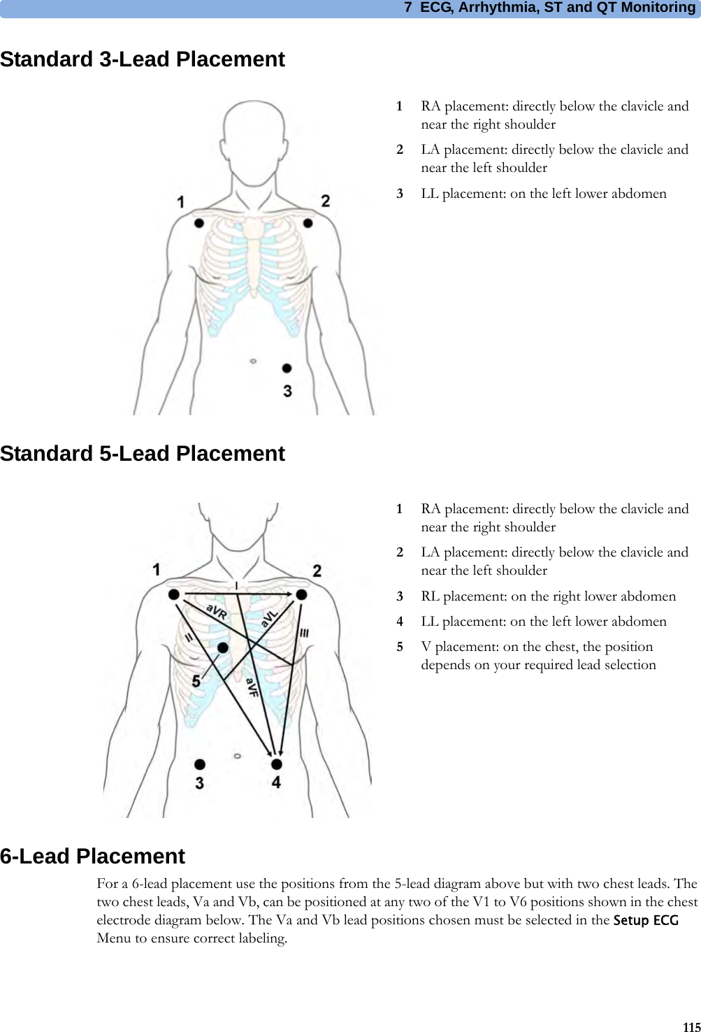 7 ECG, Arrhythmia, ST and QT Monitoring115Standard 3-Lead PlacementStandard 5-Lead Placement6-Lead PlacementFor a 6-lead placement use the positions from the 5-lead diagram above but with two chest leads. The two chest leads, Va and Vb, can be positioned at any two of the V1 to V6 positions shown in the chest electrode diagram below. The Va and Vb lead positions chosen must be selected in the Setup ECG Menu to ensure correct labeling.1RA placement: directly below the clavicle and near the right shoulder2LA placement: directly below the clavicle and near the left shoulder3LL placement: on the left lower abdomen1RA placement: directly below the clavicle and near the right shoulder2LA placement: directly below the clavicle and near the left shoulder3RL placement: on the right lower abdomen4LL placement: on the left lower abdomen5V placement: on the chest, the position depends on your required lead selection