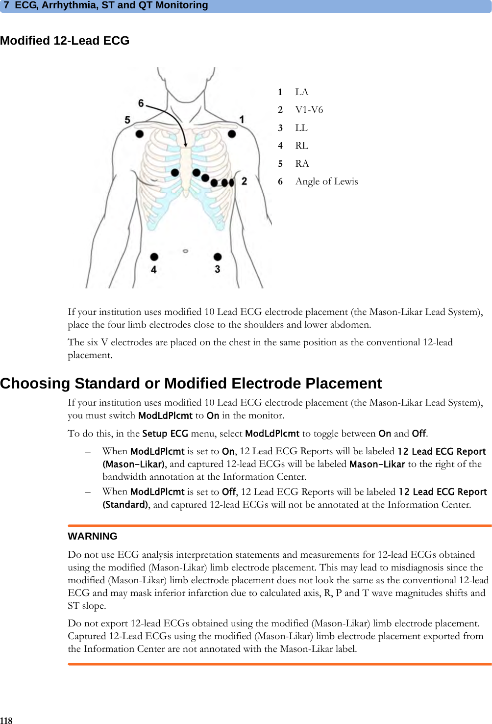 7 ECG, Arrhythmia, ST and QT Monitoring118Modified 12-Lead ECGIf your institution uses modified 10 Lead ECG electrode placement (the Mason-Likar Lead System), place the four limb electrodes close to the shoulders and lower abdomen.The six V electrodes are placed on the chest in the same position as the conventional 12-lead placement.Choosing Standard or Modified Electrode PlacementIf your institution uses modified 10 Lead ECG electrode placement (the Mason-Likar Lead System), you must switch ModLdPlcmt to On in the monitor.To do this, in the Setup ECG menu, select ModLdPlcmt to toggle between On and Off.– When ModLdPlcmt is set to On, 12 Lead ECG Reports will be labeled 12 Lead ECG Report (Mason-Likar), and captured 12-lead ECGs will be labeled Mason-Likar to the right of the bandwidth annotation at the Information Center.– When ModLdPlcmt is set to Off, 12 Lead ECG Reports will be labeled 12 Lead ECG Report (Standard), and captured 12-lead ECGs will not be annotated at the Information Center.WARNINGDo not use ECG analysis interpretation statements and measurements for 12-lead ECGs obtained using the modified (Mason-Likar) limb electrode placement. This may lead to misdiagnosis since the modified (Mason-Likar) limb electrode placement does not look the same as the conventional 12-lead ECG and may mask inferior infarction due to calculated axis, R, P and T wave magnitudes shifts and ST slope.Do not export 12-lead ECGs obtained using the modified (Mason-Likar) limb electrode placement. Captured 12-Lead ECGs using the modified (Mason-Likar) limb electrode placement exported from the Information Center are not annotated with the Mason-Likar label.1LA2V1-V63LL4RL5RA6Angle of Lewis