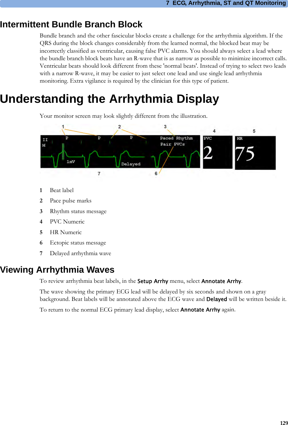 7 ECG, Arrhythmia, ST and QT Monitoring129Intermittent Bundle Branch BlockBundle branch and the other fascicular blocks create a challenge for the arrhythmia algorithm. If the QRS during the block changes considerably from the learned normal, the blocked beat may be incorrectly classified as ventricular, causing false PVC alarms. You should always select a lead where the bundle branch block beats have an R-wave that is as narrow as possible to minimize incorrect calls. Ventricular beats should look different from these &apos;normal beats&apos;. Instead of trying to select two leads with a narrow R-wave, it may be easier to just select one lead and use single lead arrhythmia monitoring. Extra vigilance is required by the clinician for this type of patient.Understanding the Arrhythmia DisplayYour monitor screen may look slightly different from the illustration.1Beat label2Pace pulse marks3Rhythm status message4PVC Numeric5HR Numeric6Ectopic status message7Delayed arrhythmia waveViewing Arrhythmia WavesTo review arrhythmia beat labels, in the Setup Arrhy menu, select Annotate Arrhy.The wave showing the primary ECG lead will be delayed by six seconds and shown on a gray background. Beat labels will be annotated above the ECG wave and Delayed will be written beside it.To return to the normal ECG primary lead display, select Annotate Arrhy again.