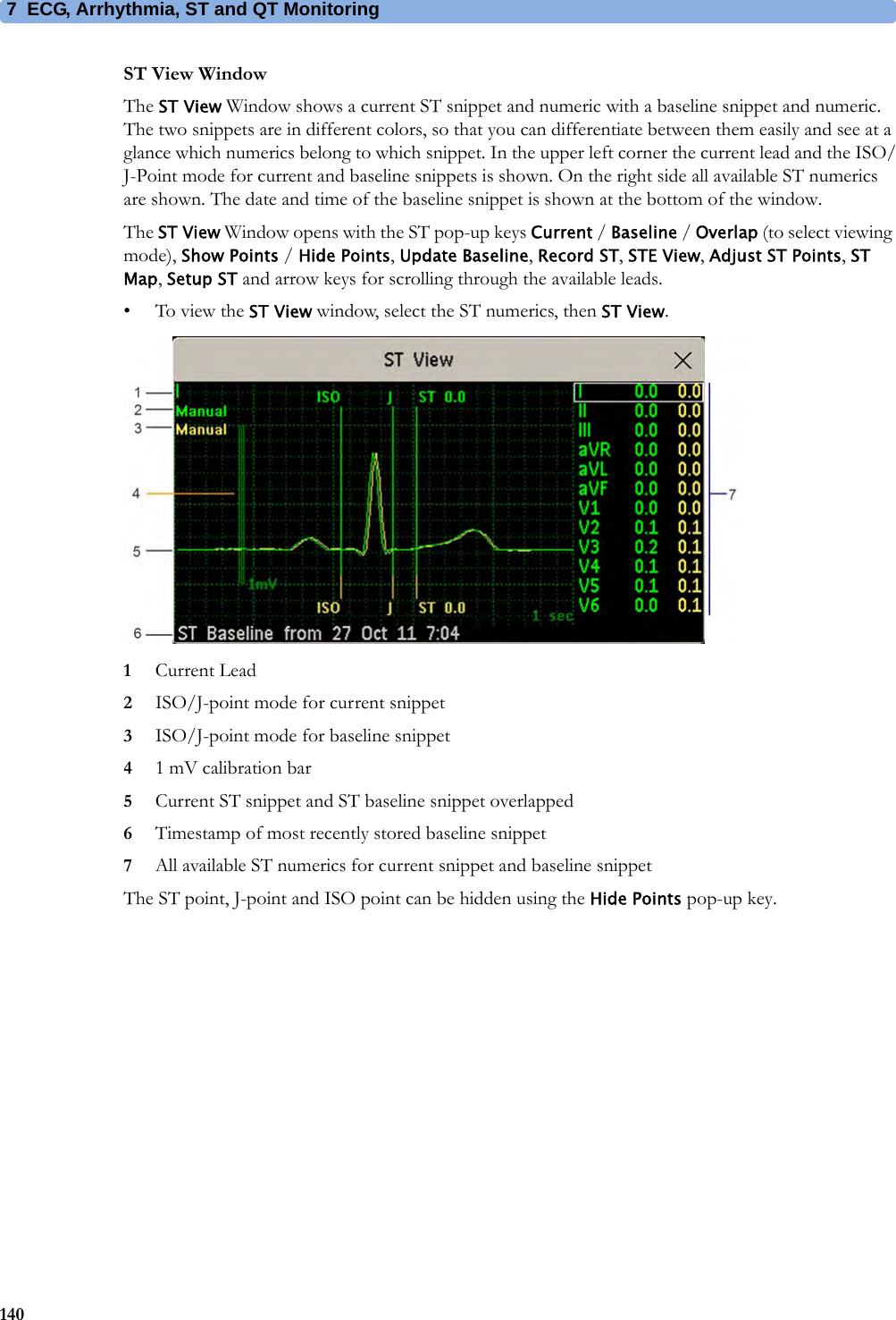 7 ECG, Arrhythmia, ST and QT Monitoring140ST View WindowThe ST View Window shows a current ST snippet and numeric with a baseline snippet and numeric. The two snippets are in different colors, so that you can differentiate between them easily and see at a glance which numerics belong to which snippet. In the upper left corner the current lead and the ISO/J-Point mode for current and baseline snippets is shown. On the right side all available ST numerics are shown. The date and time of the baseline snippet is shown at the bottom of the window. The ST View Window opens with the ST pop-up keys Current / Baseline / Overlap (to select viewing mode), Show Points / Hide Points, Update Baseline, Record ST, STE View, Adjust ST Points, ST Map, Setup ST and arrow keys for scrolling through the available leads.• To view the ST View window, select the ST numerics, then ST View.1Current Lead2ISO/J-point mode for current snippet3ISO/J-point mode for baseline snippet41 mV calibration bar5Current ST snippet and ST baseline snippet overlapped6Timestamp of most recently stored baseline snippet7All available ST numerics for current snippet and baseline snippetThe ST point, J-point and ISO point can be hidden using the Hide Points pop-up key.