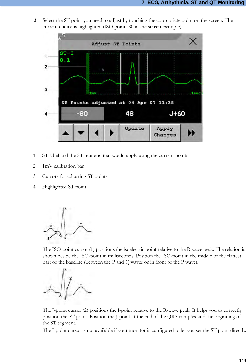 7 ECG, Arrhythmia, ST and QT Monitoring1433Select the ST point you need to adjust by touching the appropriate point on the screen. The current choice is highlighted (ISO point -80 in the screen example).The ISO-point cursor (1) positions the isoelectric point relative to the R-wave peak. The relation is shown beside the ISO-point in milliseconds. Position the ISO-point in the middle of the flattest part of the baseline (between the P and Q waves or in front of the P wave).The J-point cursor (2) positions the J-point relative to the R-wave peak. It helps you to correctly position the ST-point. Position the J-point at the end of the QRS complex and the beginning of the ST segment.The J-point cursor is not available if your monitor is configured to let you set the ST point directly.1 ST label and the ST numeric that would apply using the current points2 1mV calibration bar3 Cursors for adjusting ST points4 Highlighted ST point