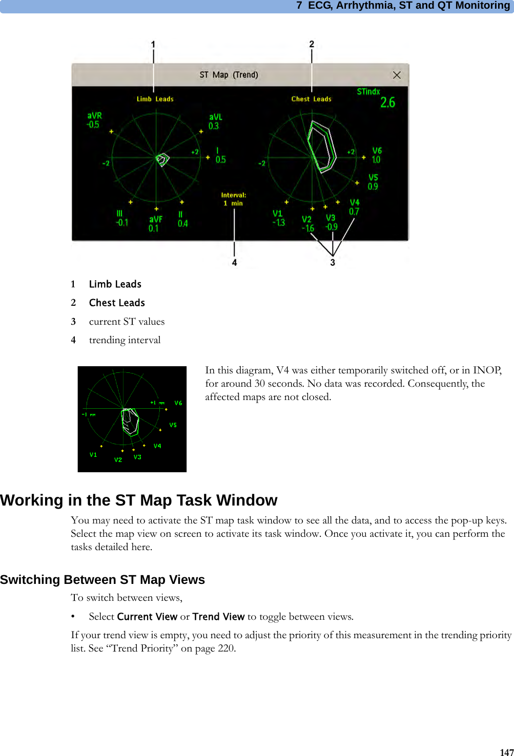 7 ECG, Arrhythmia, ST and QT Monitoring1471Limb Leads2Chest Leads3current ST values4trending intervalWorking in the ST Map Task WindowYou may need to activate the ST map task window to see all the data, and to access the pop-up keys. Select the map view on screen to activate its task window. Once you activate it, you can perform the tasks detailed here.Switching Between ST Map ViewsTo switch between views,•Select Current View or Trend View to toggle between views.If your trend view is empty, you need to adjust the priority of this measurement in the trending priority list. See “Trend Priority” on page 220.In this diagram, V4 was either temporarily switched off, or in INOP, for around 30 seconds. No data was recorded. Consequently, the affected maps are not closed.