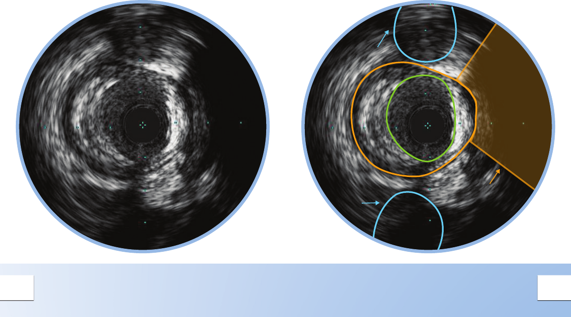 Philips 89000 User Manual Rotational IVUS Image Interpretation Pocket