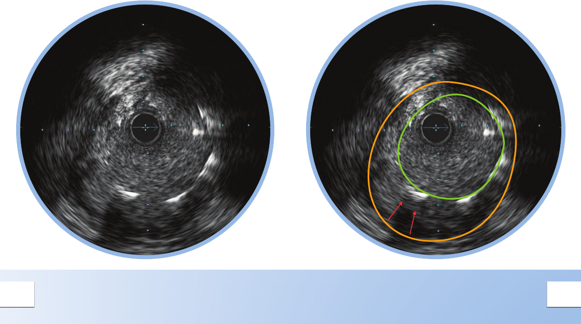 Philips 89000 User Manual Rotational IVUS Image Interpretation Pocket