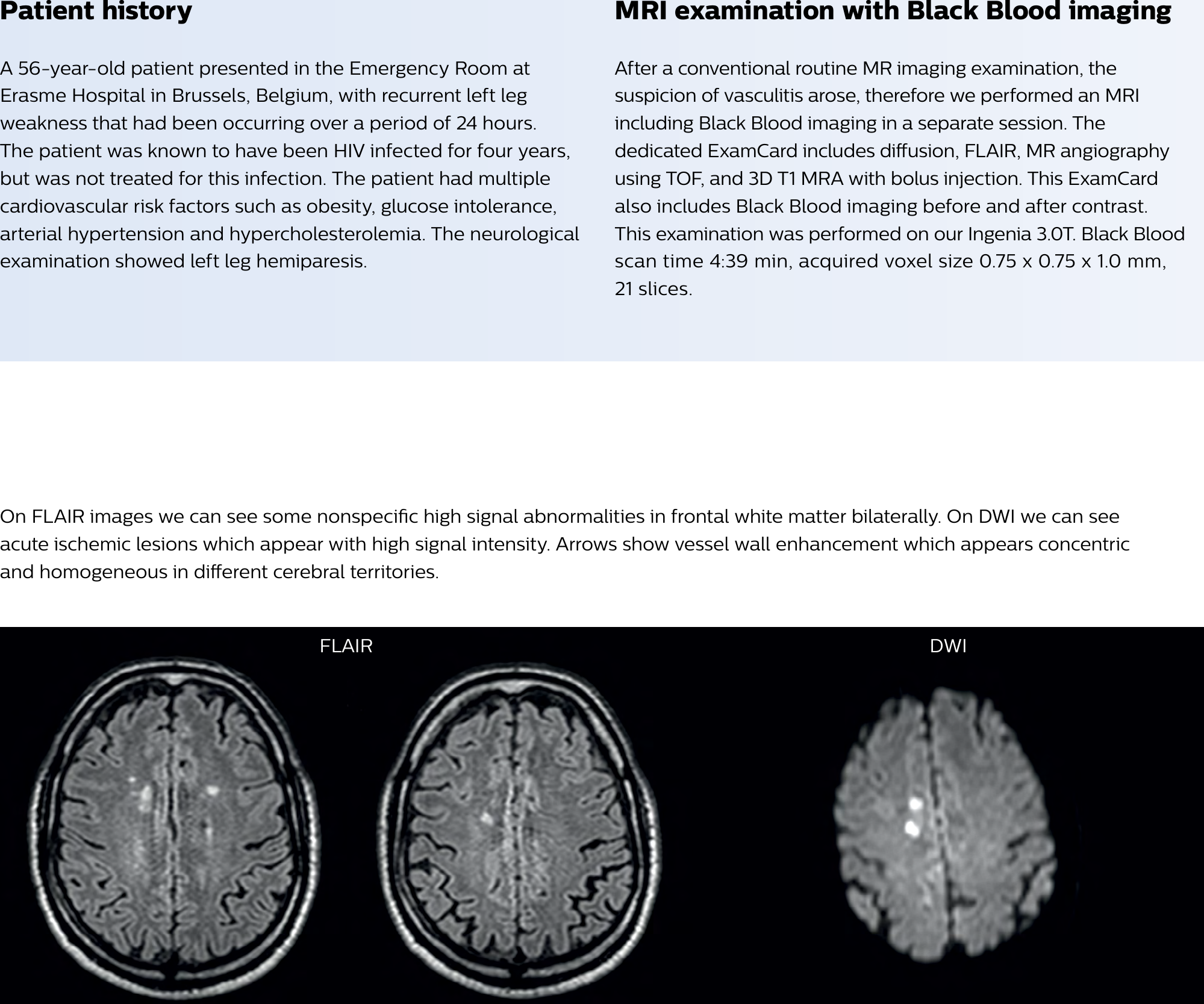 Page 2 of 8 - Philips  This Field Strength Article Black Blood MRI Of HIV Patient With Vasculitis
