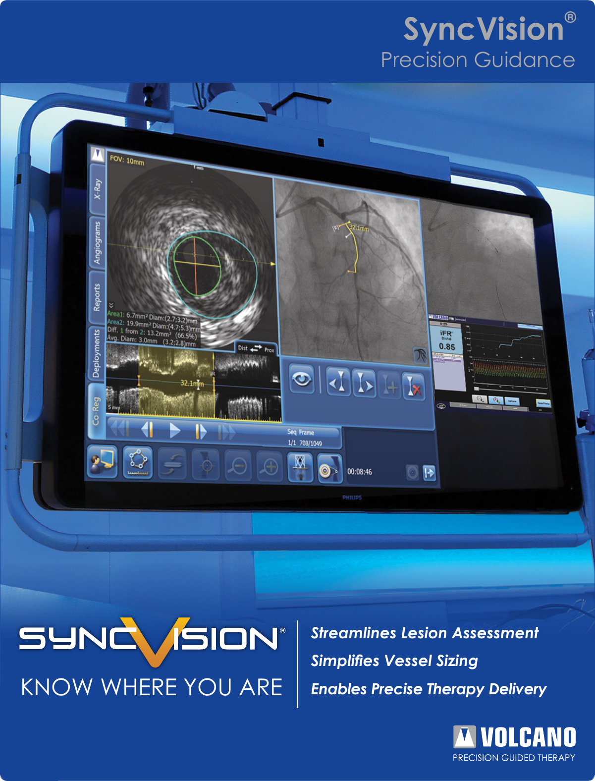 Page 1 of 2 - Philips IGTDSYNC User Manual Product Brochure Volcano Sync Vision Precision Guidance System Bcc9ea107e3241339020a77c0151ba26