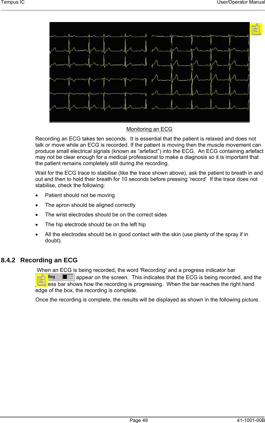Tempus IC    User/Operator Manual     Monitoring an ECG Recording an ECG takes ten seconds.  It is essential that the patient is relaxed and does not talk or move while an ECG is recorded. If the patient is moving then the muscle movement can produce small electrical signals (known as “artefact”) into the ECG.  An ECG containing artefact may not be clear enough for a medical professional to make a diagnosis so it is important that the patient remains completely still during the recording. Wait for the ECG trace to stabilise (like the trace shown above), ask the patient to breath in and out and then to hold their breath for 10 seconds before pressing ‘record’  If the trace does not stabilise, check the following: •  Patient should not be moving •  The apron should be aligned correctly •  The wrist electrodes should be on the correct sides •  The hip electrode should be on the left hip •  All the electrodes should be in good contact with the skin (use plenty of the spray if in doubt).  8.4.2  Recording an ECG  When an ECG is being recorded, the word &apos;Recording&apos; and a progress indicator bar  appear on the screen.  This indicates that the ECG is being recorded, and the progress bar shows how the recording is progressing.  When the bar reaches the right hand edge of the box, the recording is complete.  Once the recording is complete, the results will be displayed as shown in the following picture.     Page 49   41-1001-00B 